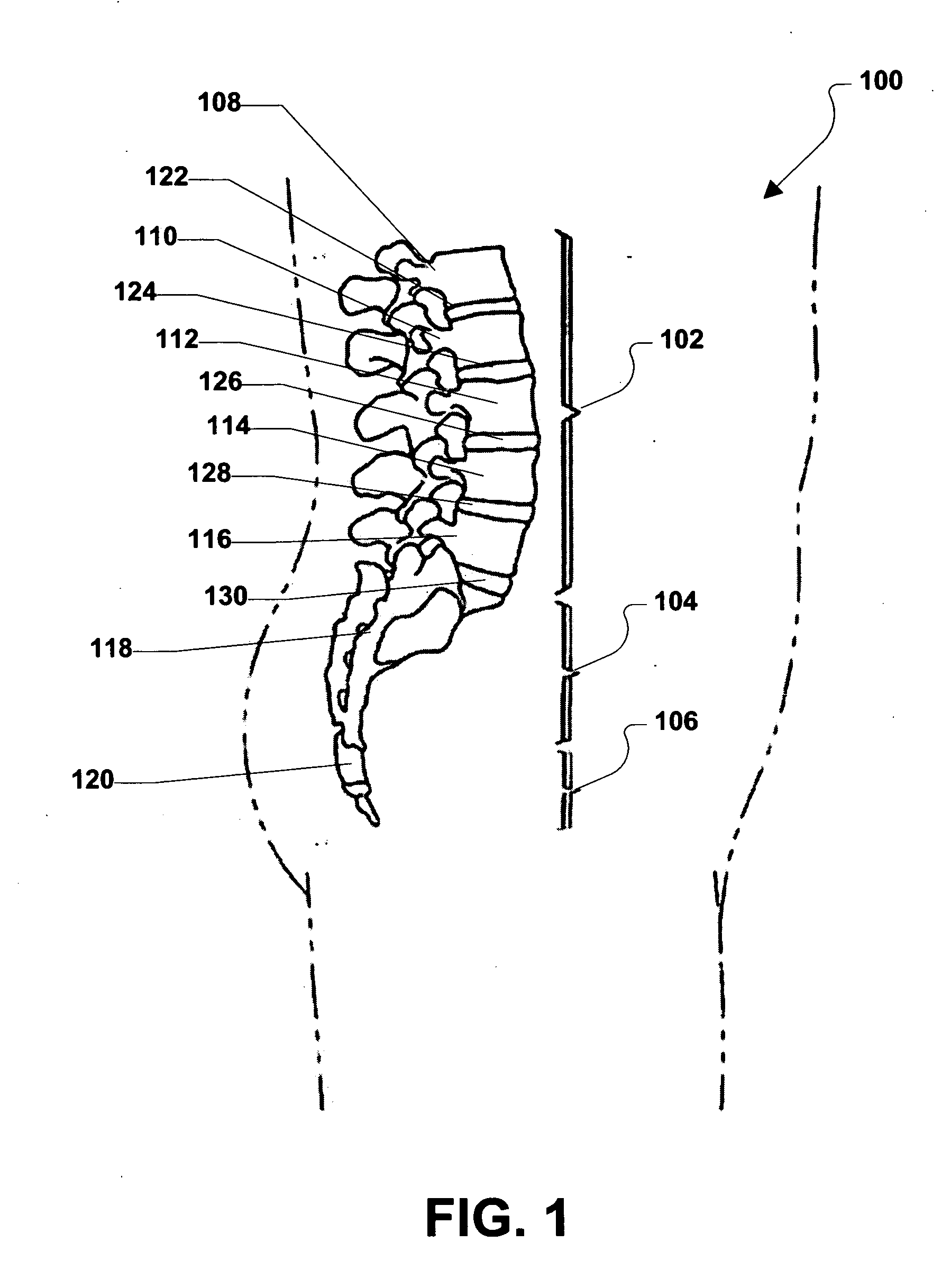 Spinal implant with improved surface properties for delivery
