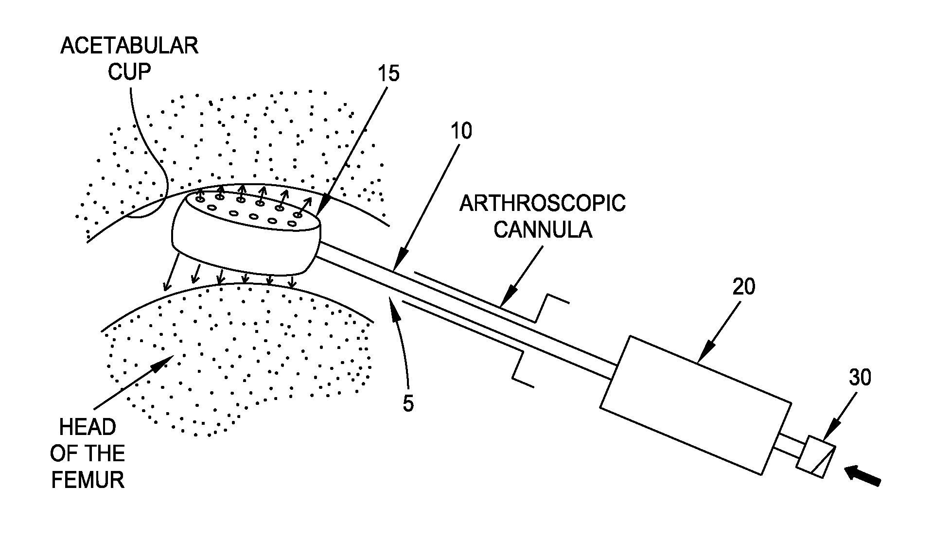 Method and apparatus for distracting a joint, including the provision and use of a novel fluid joint spacer