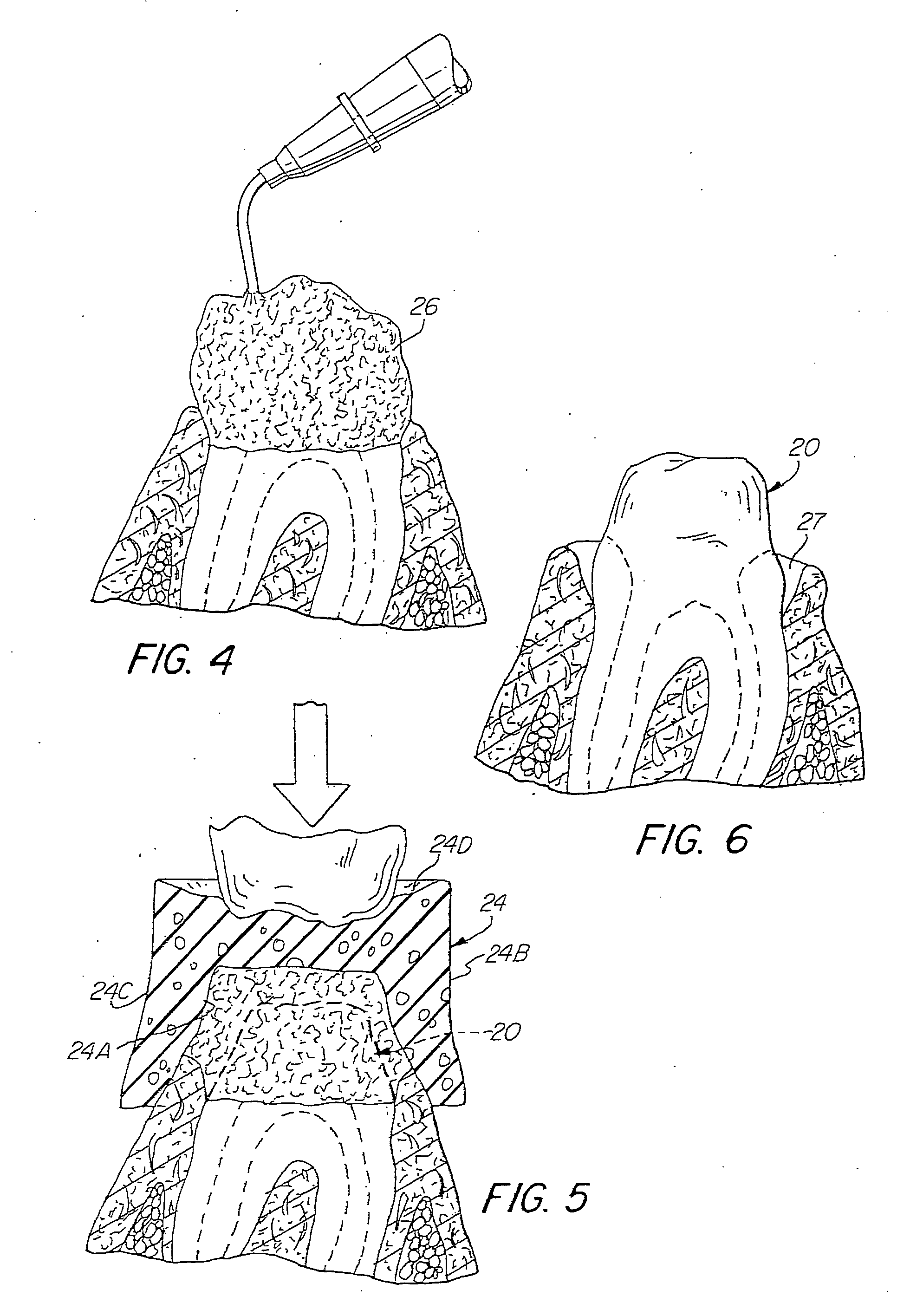 Gingival tissue retraction device and method