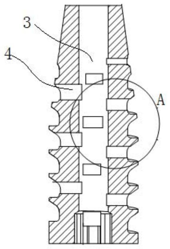 A zinc-manganese-magnesium alloy interface screw for reconstruction and fixation of anterior cruciate ligament