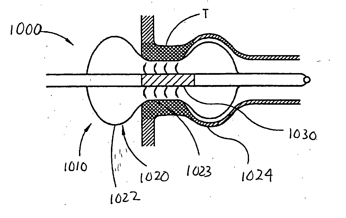 Circumferential ablation device assembly with an expandable member