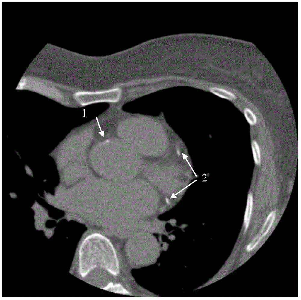 Full-automatic CT image coronary artery calcification score calculating method