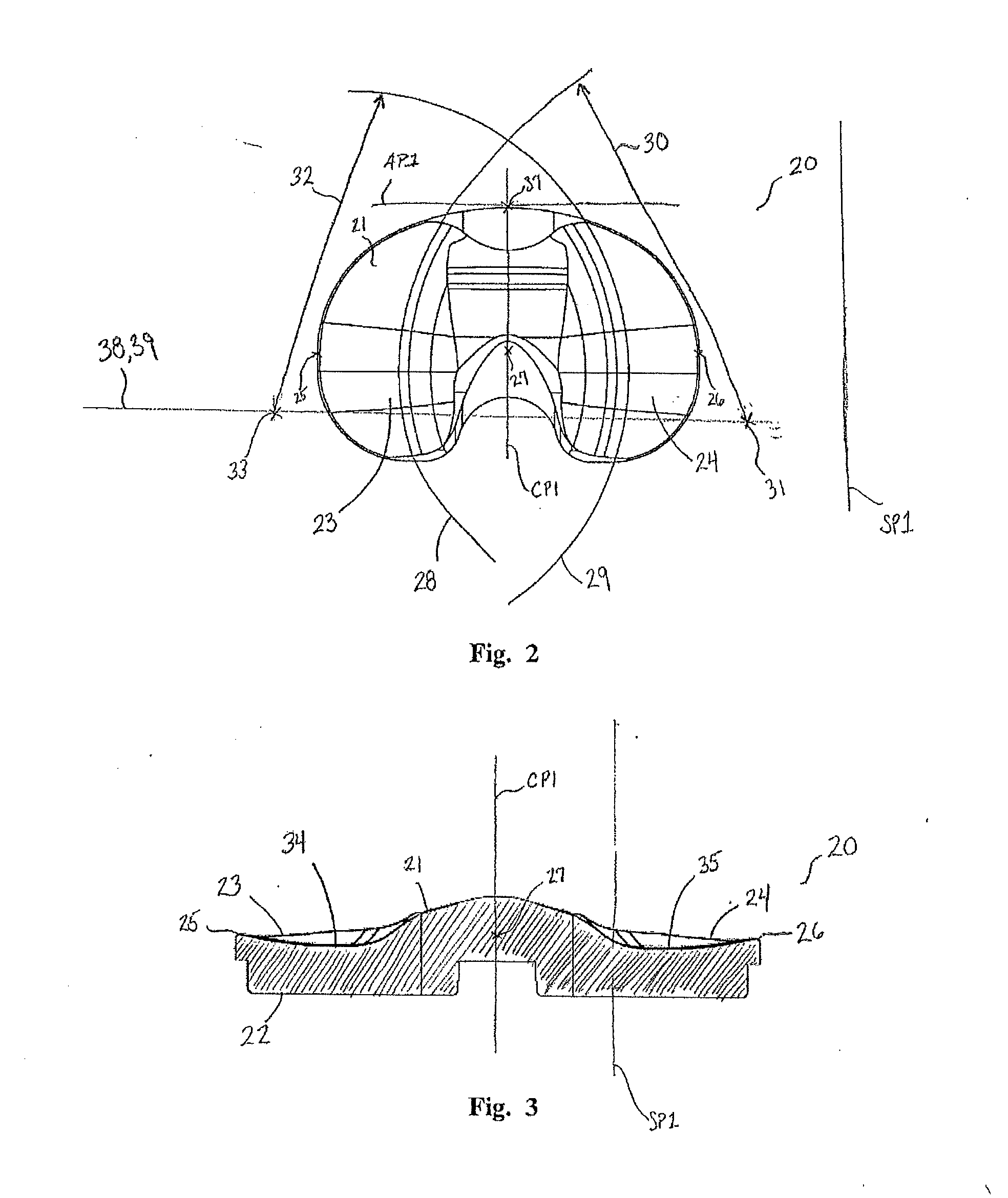 Prosthetic implant and associated instruments