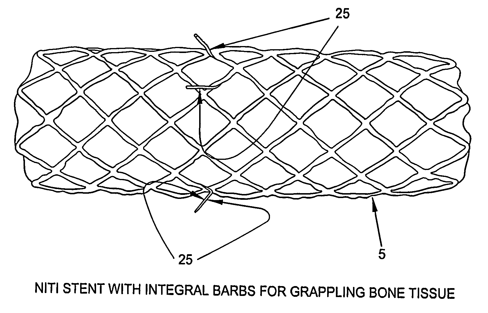 Osteosynthetic shape memory material intramedullary bone stent and method for treating a bone fracture using the same