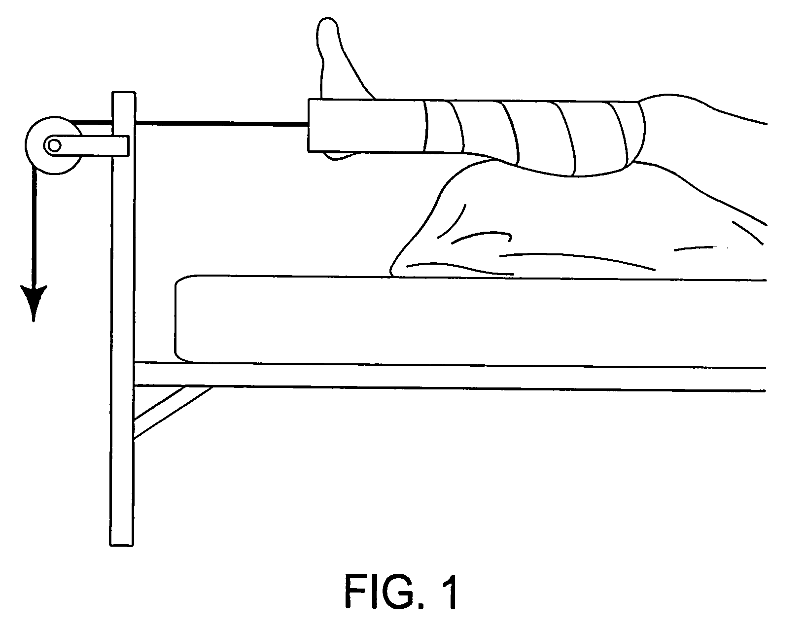 Osteosynthetic shape memory material intramedullary bone stent and method for treating a bone fracture using the same