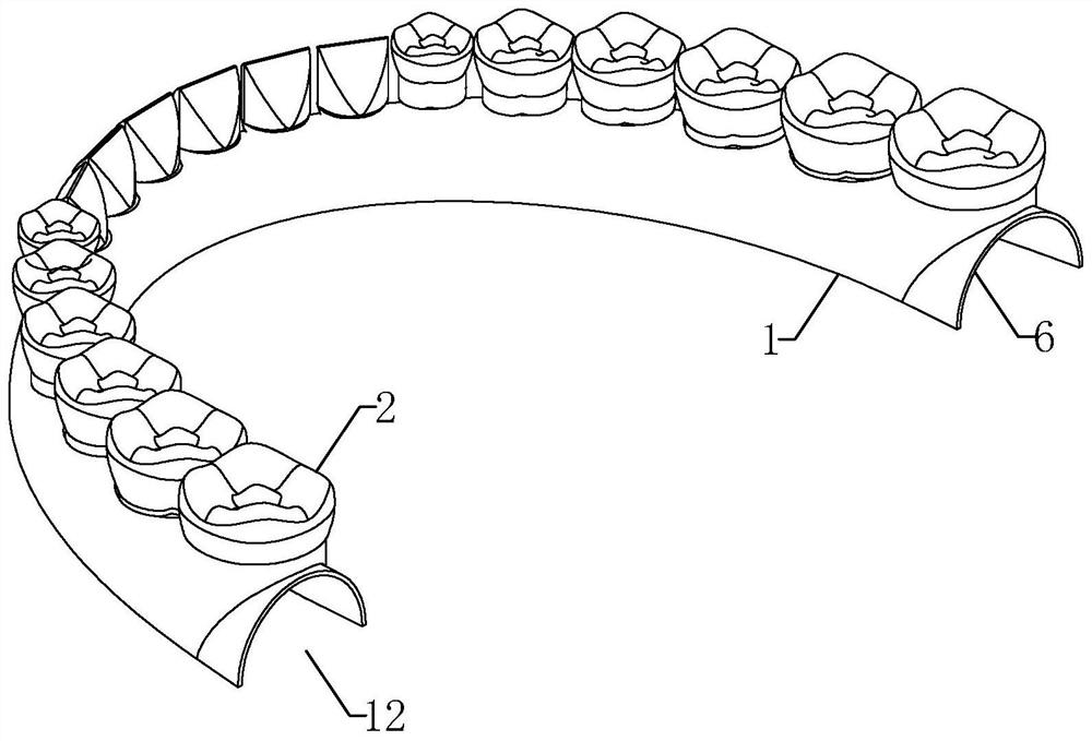 Removable denture