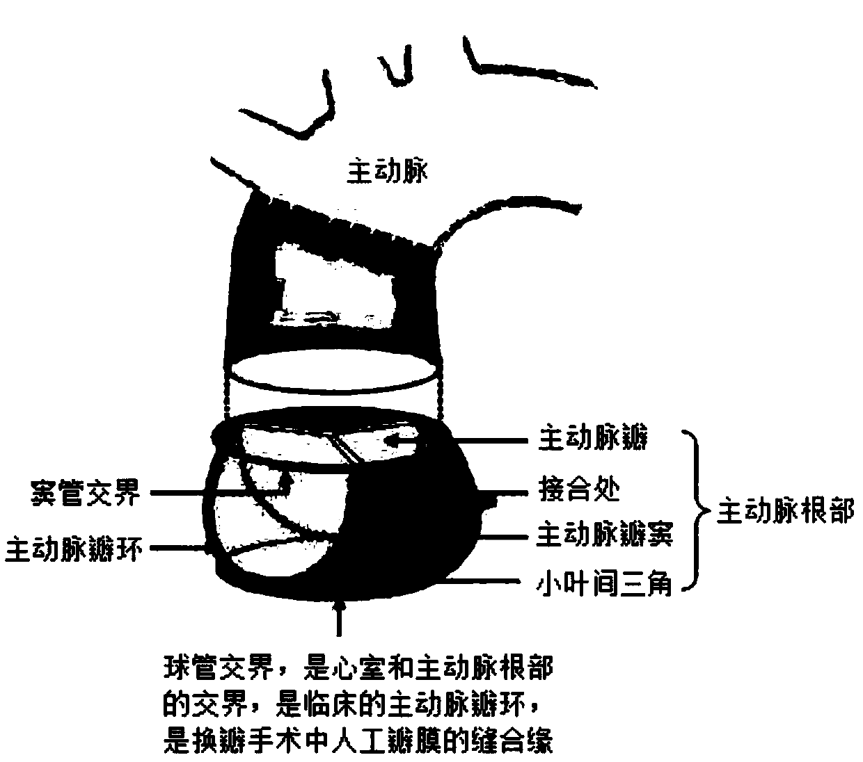 Adjustable externally implanted aortic valve forming ring