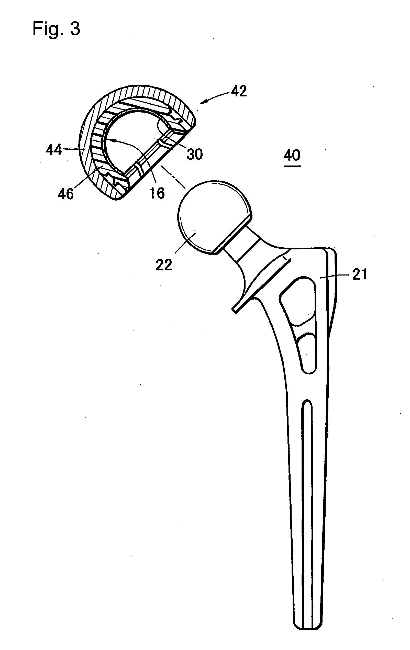 High Wear-Resistant Bearing Material and Artificial Joint Replacement Using the Same