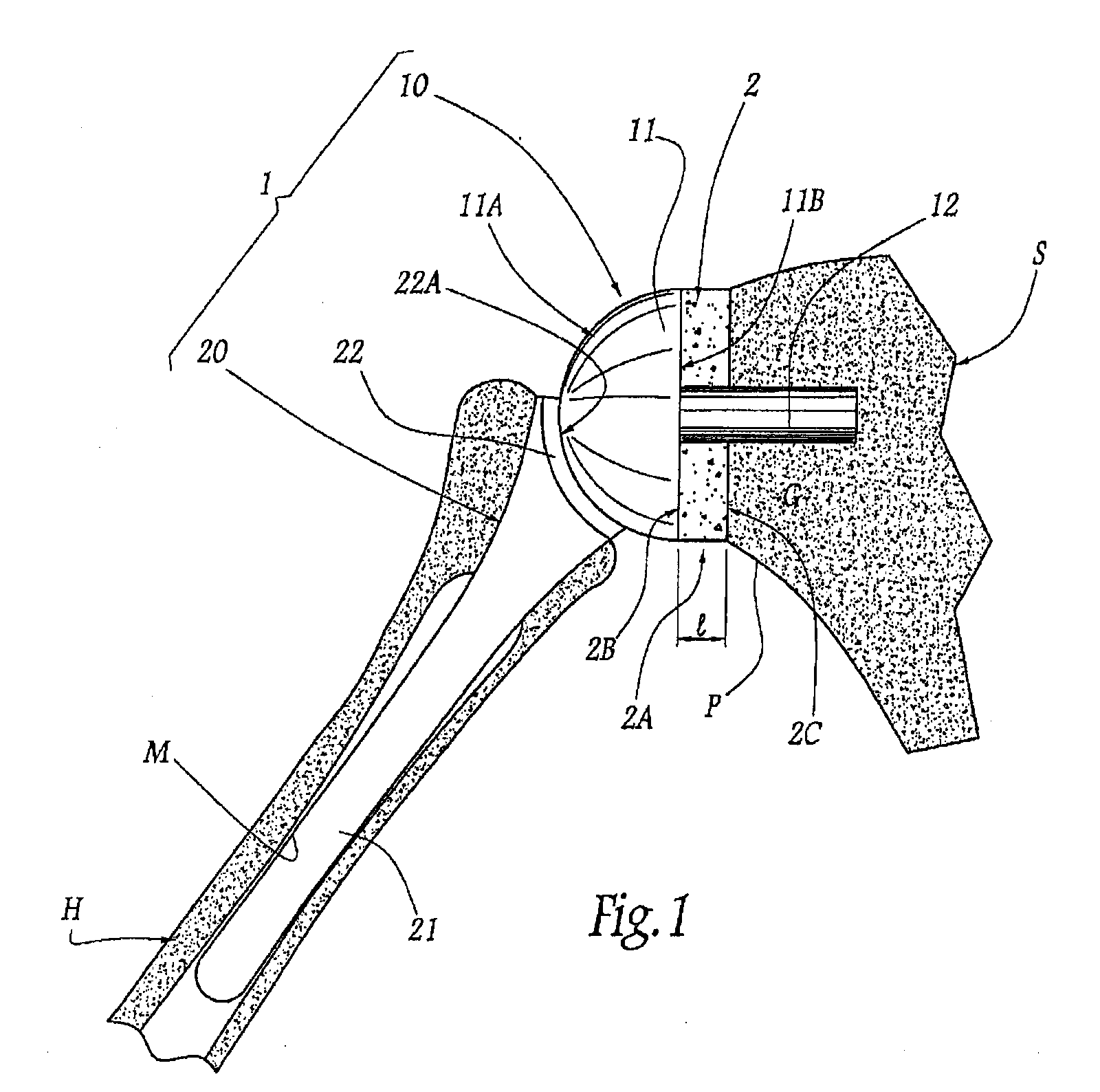 Method and apparatus for fitting a shoulder prosthesis