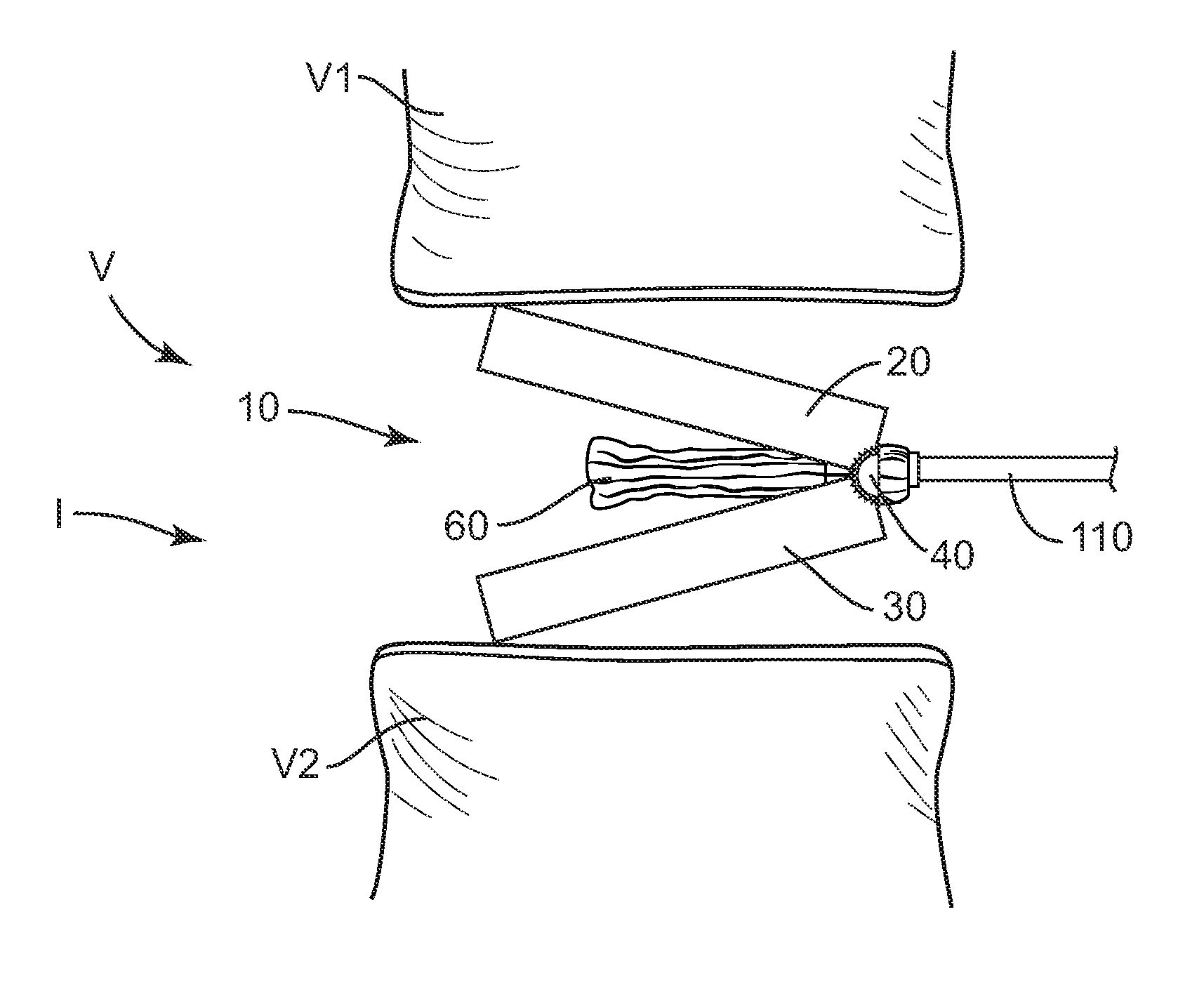 Expandable implant system and methods of use