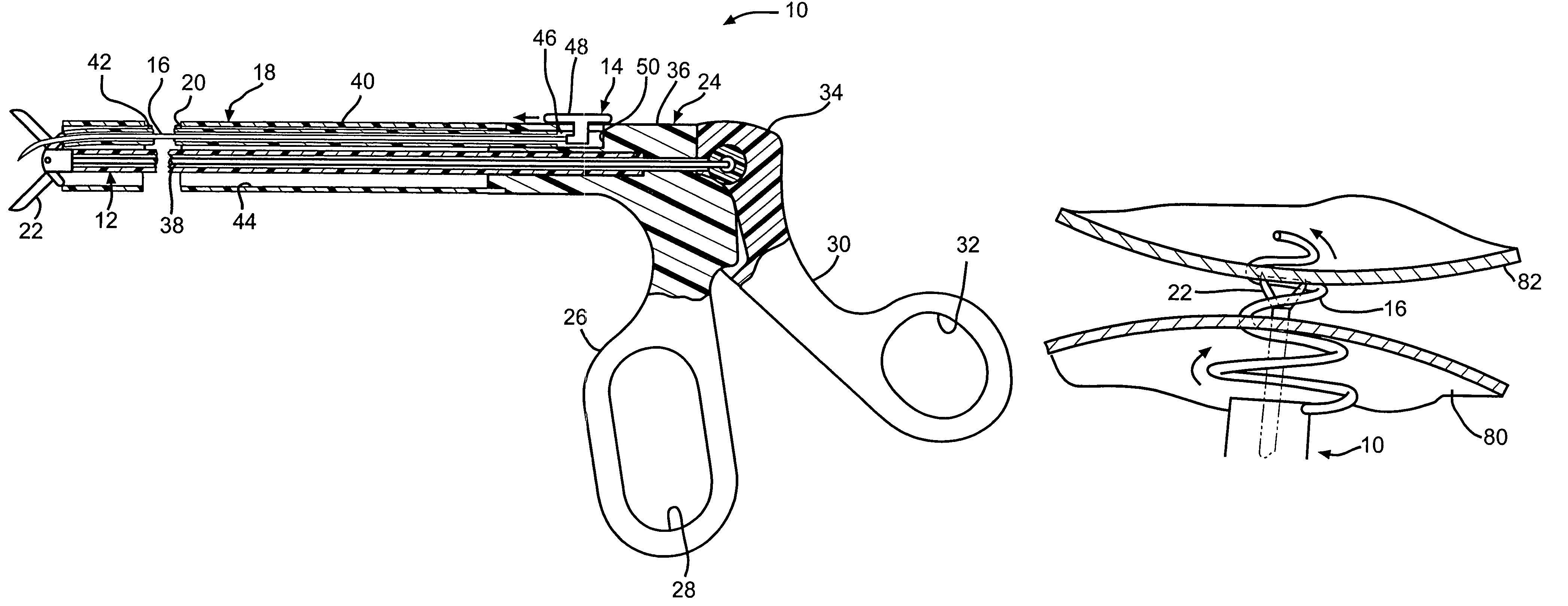 Device and method for intralumenal anastomosis
