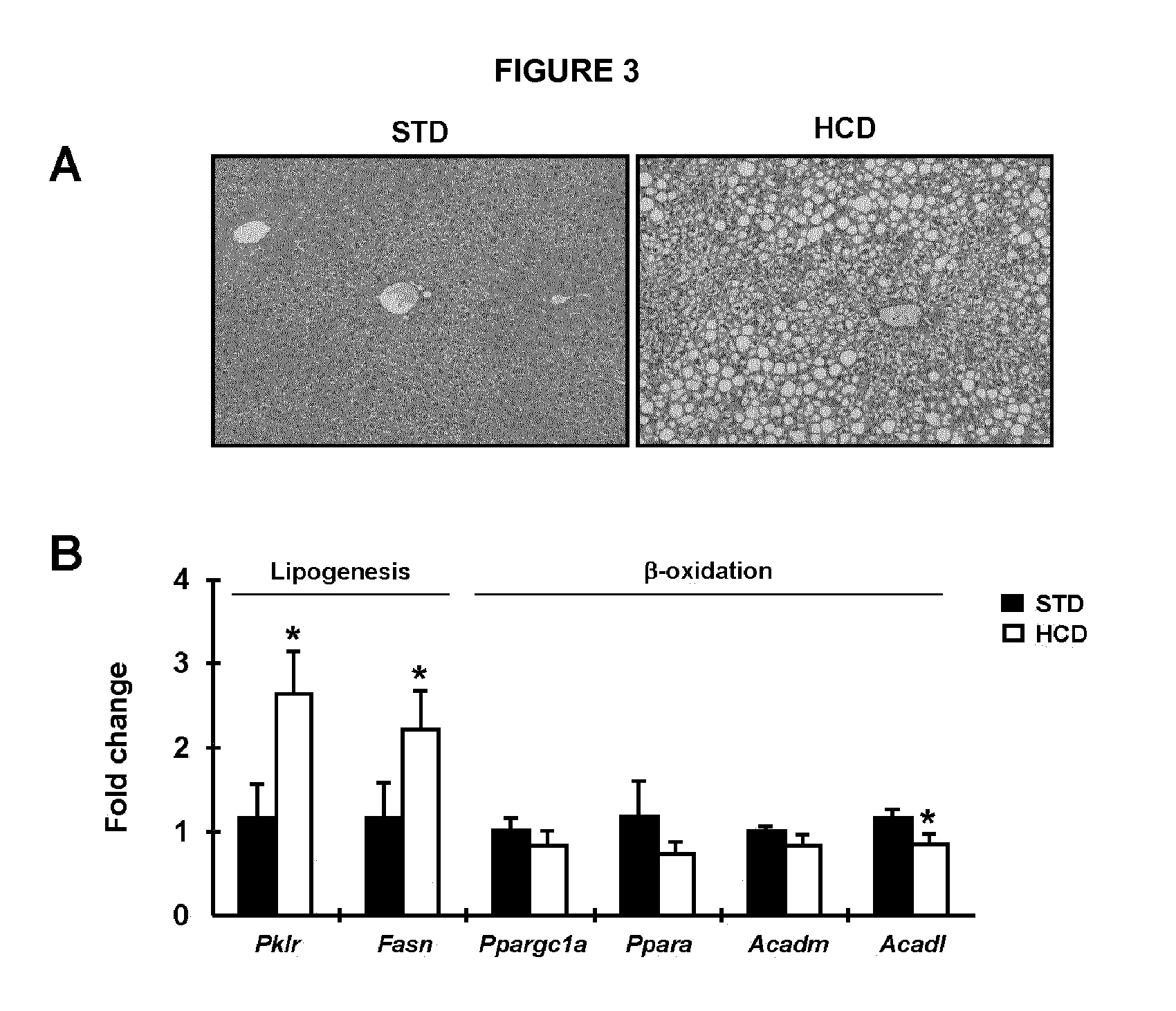 Gene therapy compositions for use in the prevention and/or treatment of non-alcoholic fatty liver disease