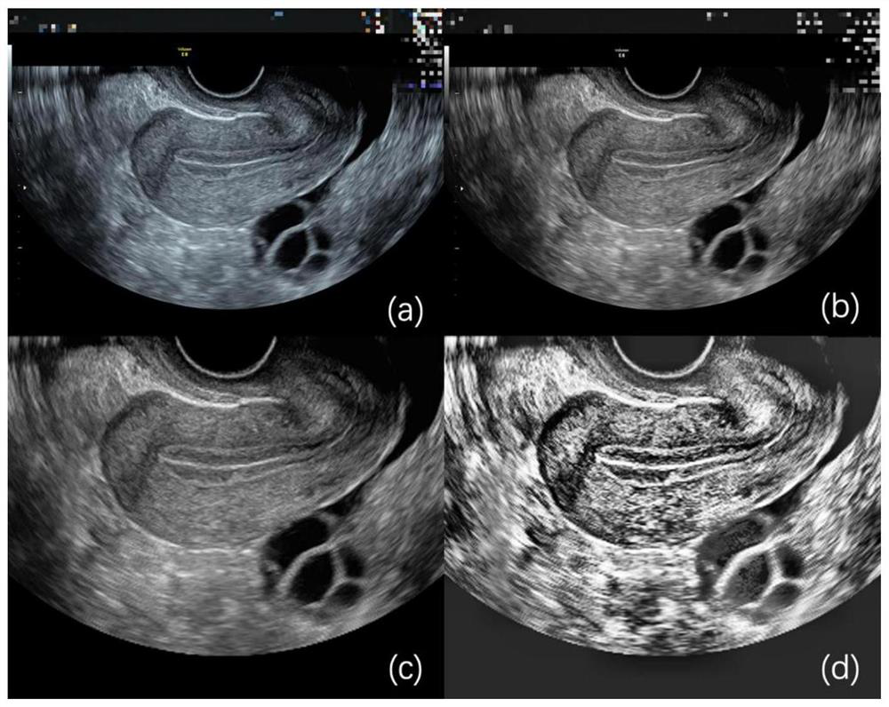 Automatic segmentation typing and thickness measuring method based on endometrial ultrasound image