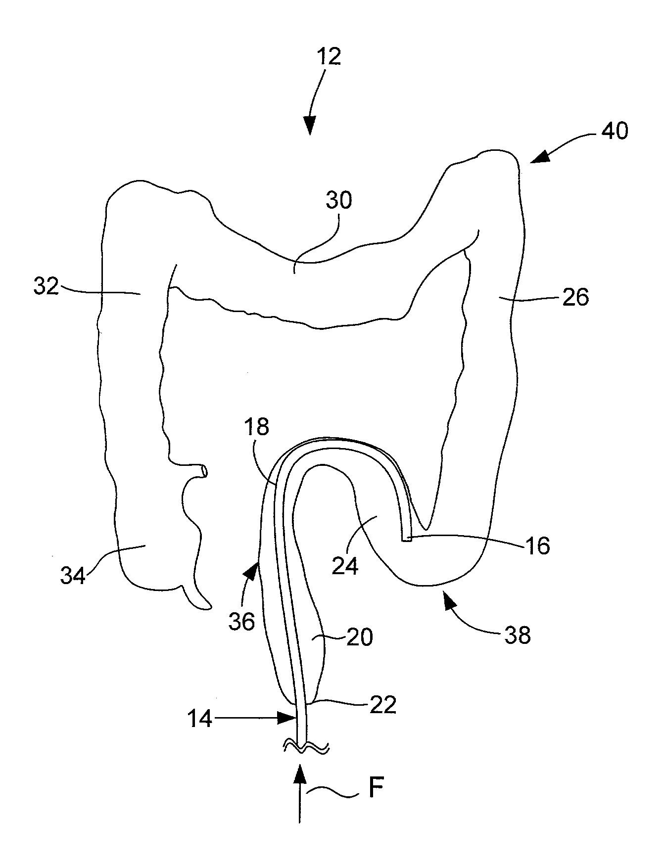 Colonoscope Guide and Method of Use for Improved Colonoscopy