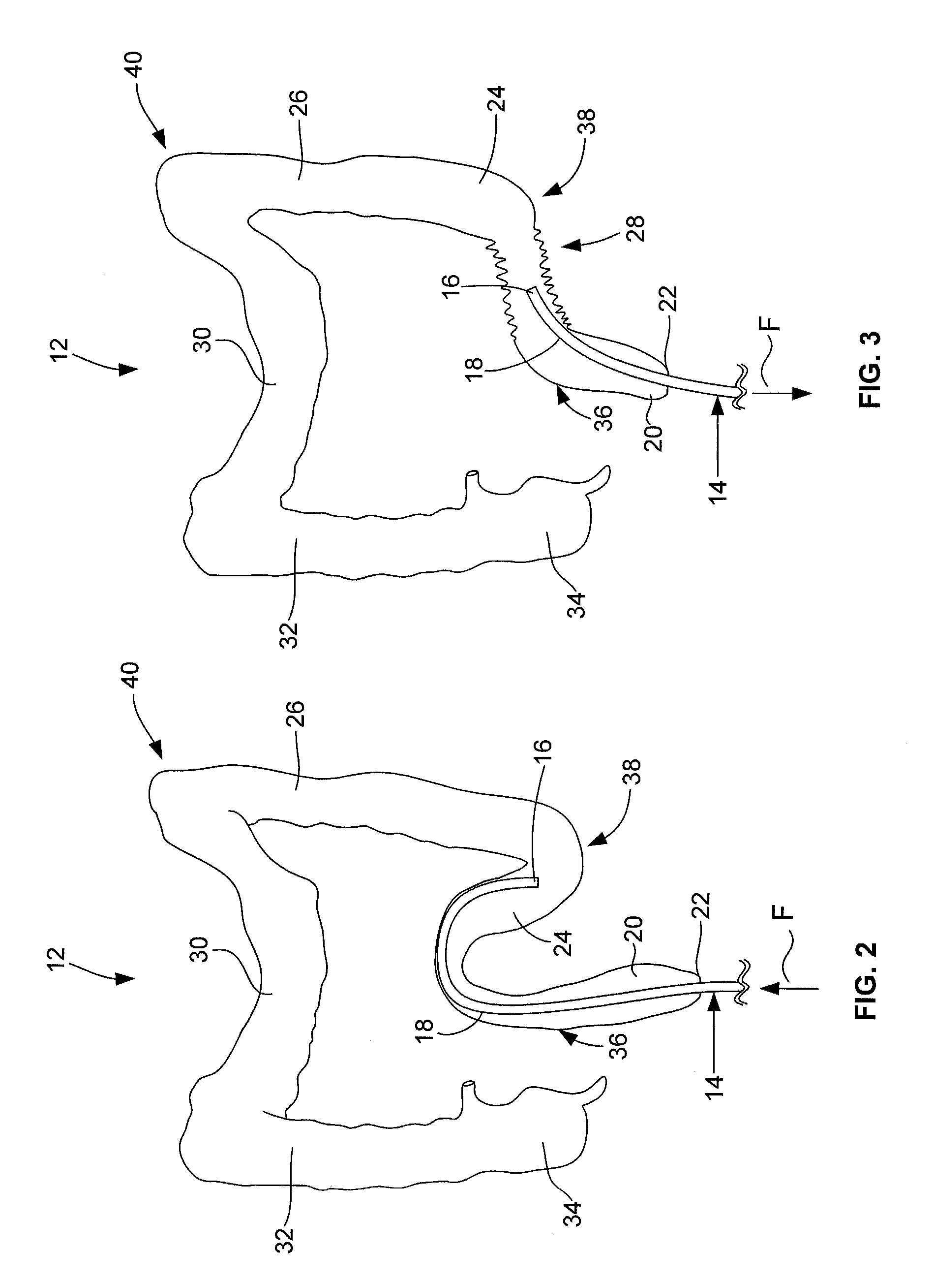 Colonoscope Guide and Method of Use for Improved Colonoscopy