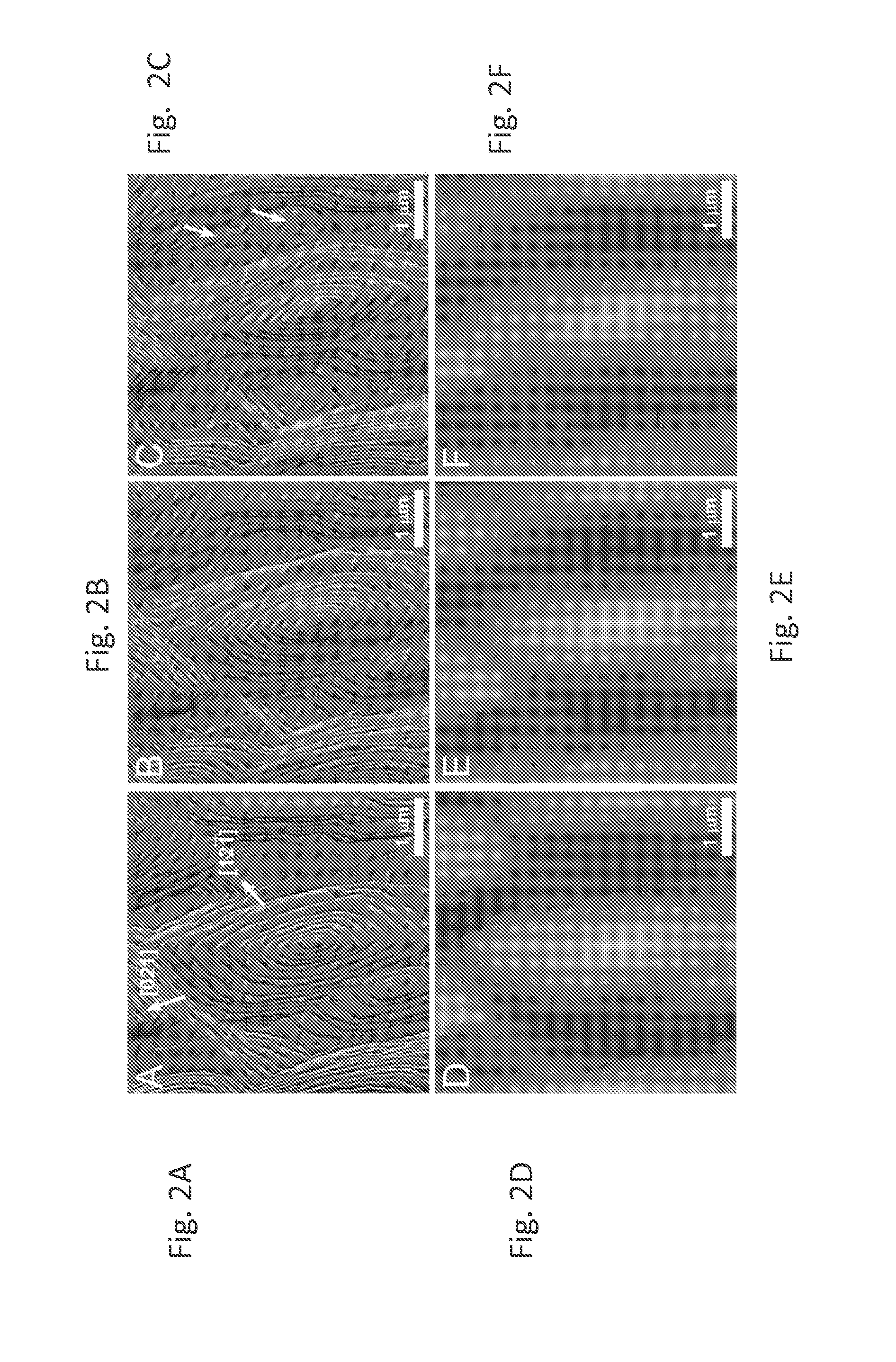 Organic acids as agents to dissolve calcium minerals in pathological calcification and uses thereof