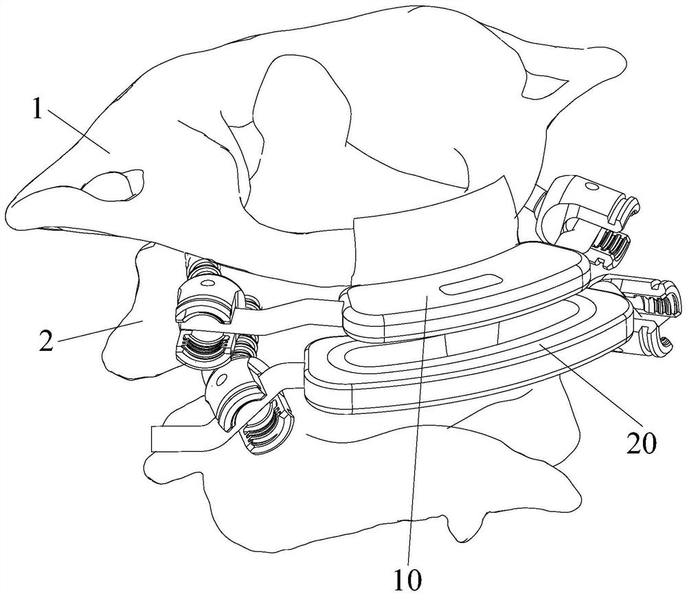 Atlantoaxial joint prosthesis