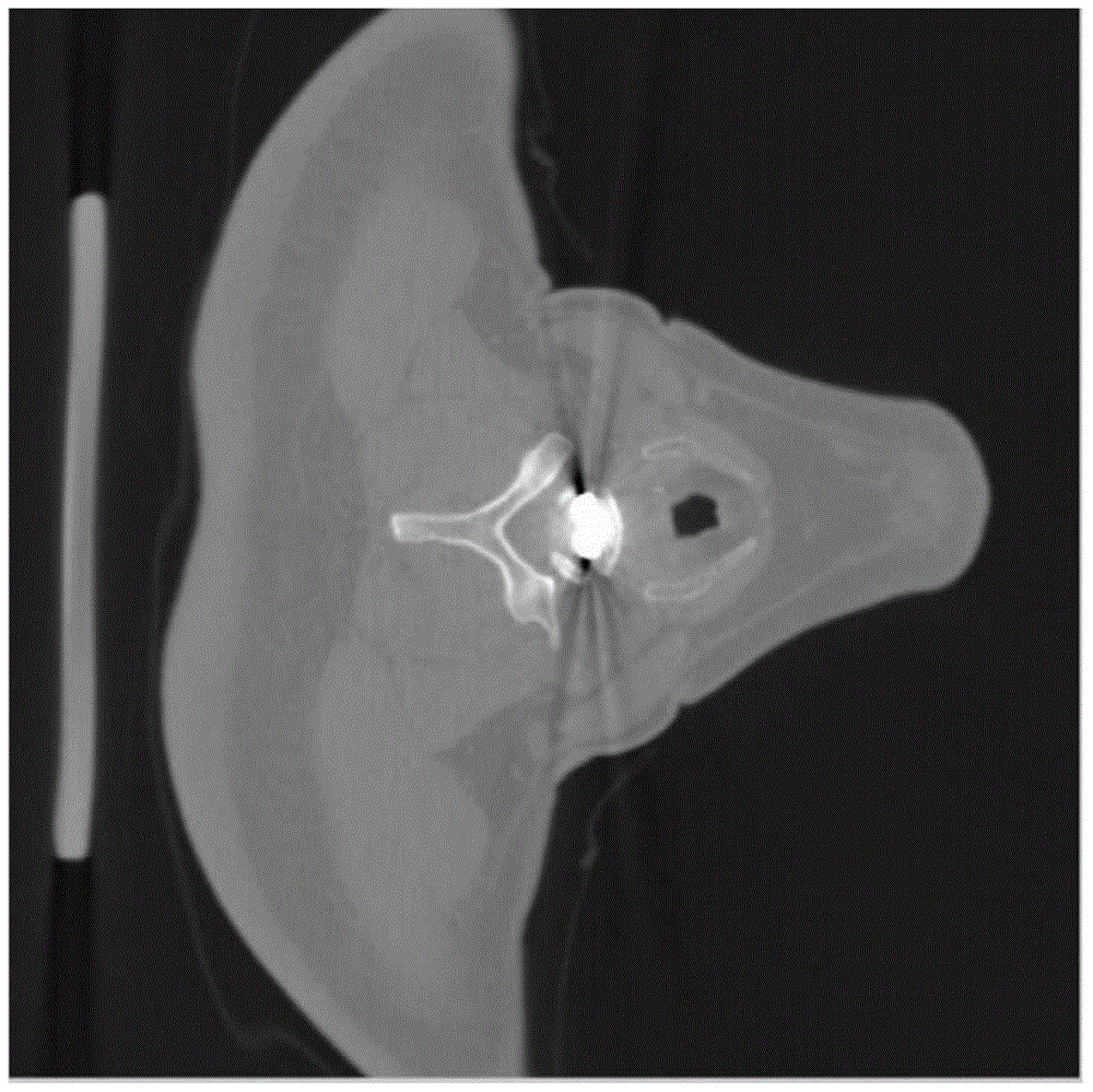 Method of removing metal artifact from CT image