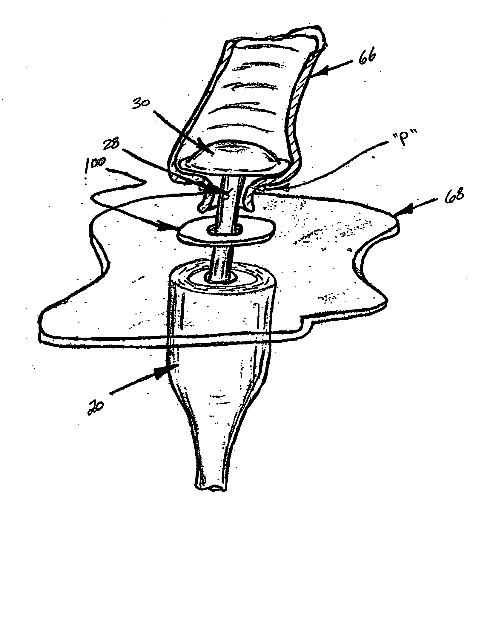 Annular disk for reduction of anastomotic tension and methods of using the same