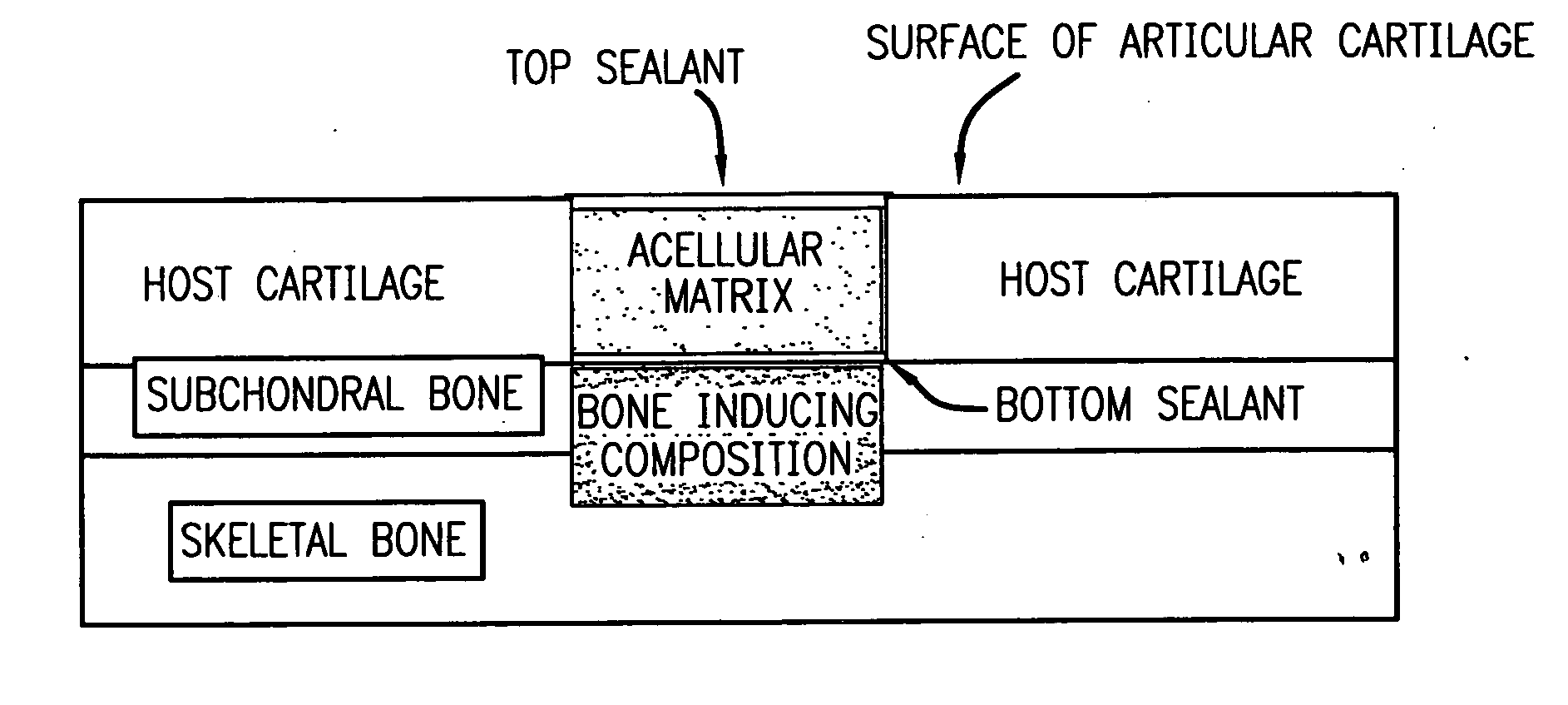 Acellular matrix implants for treatment of articular cartilage, bone or osteochondral defects and injuries and method for use thereof