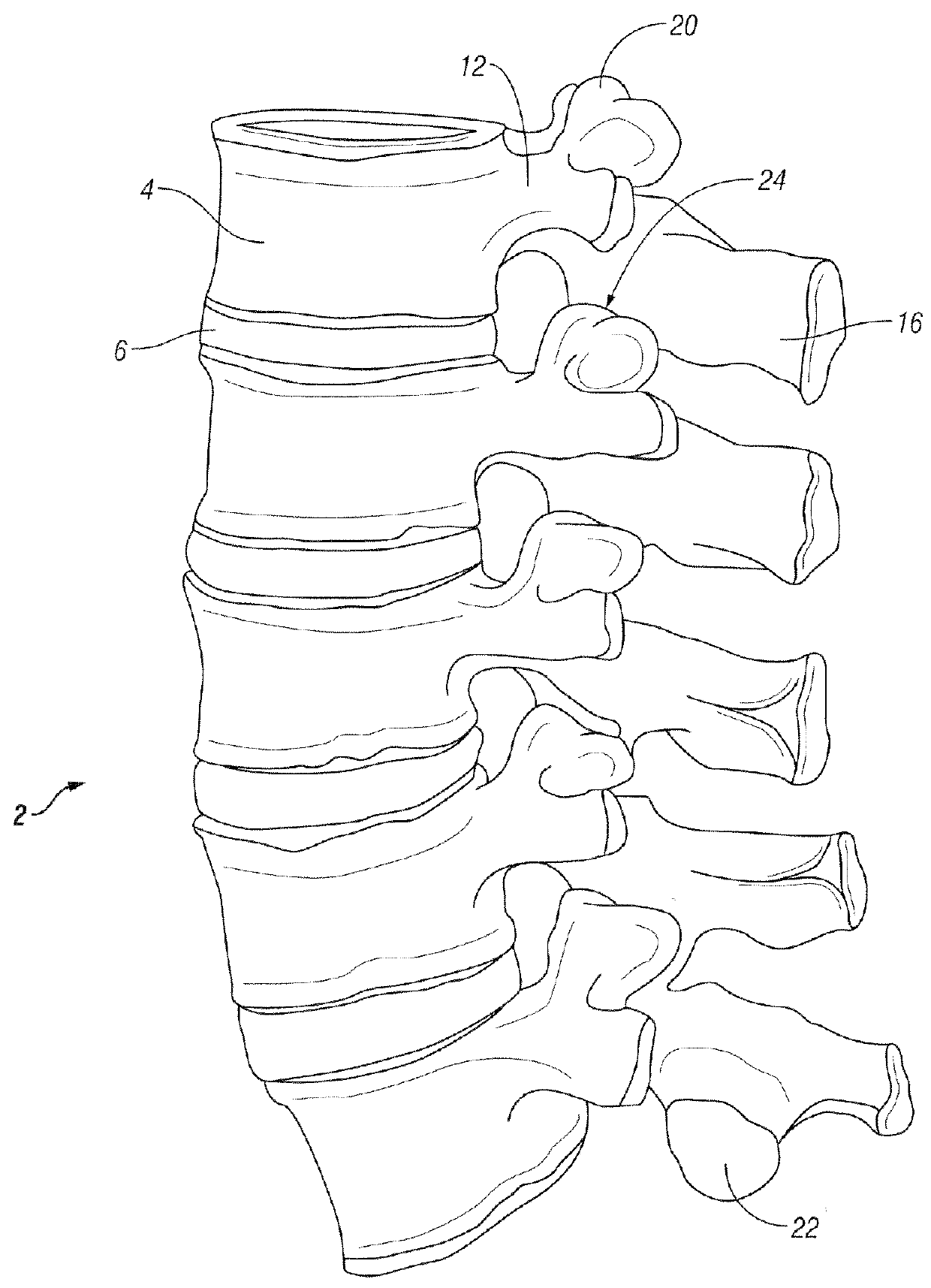 Method for accessing a spinal facet joint