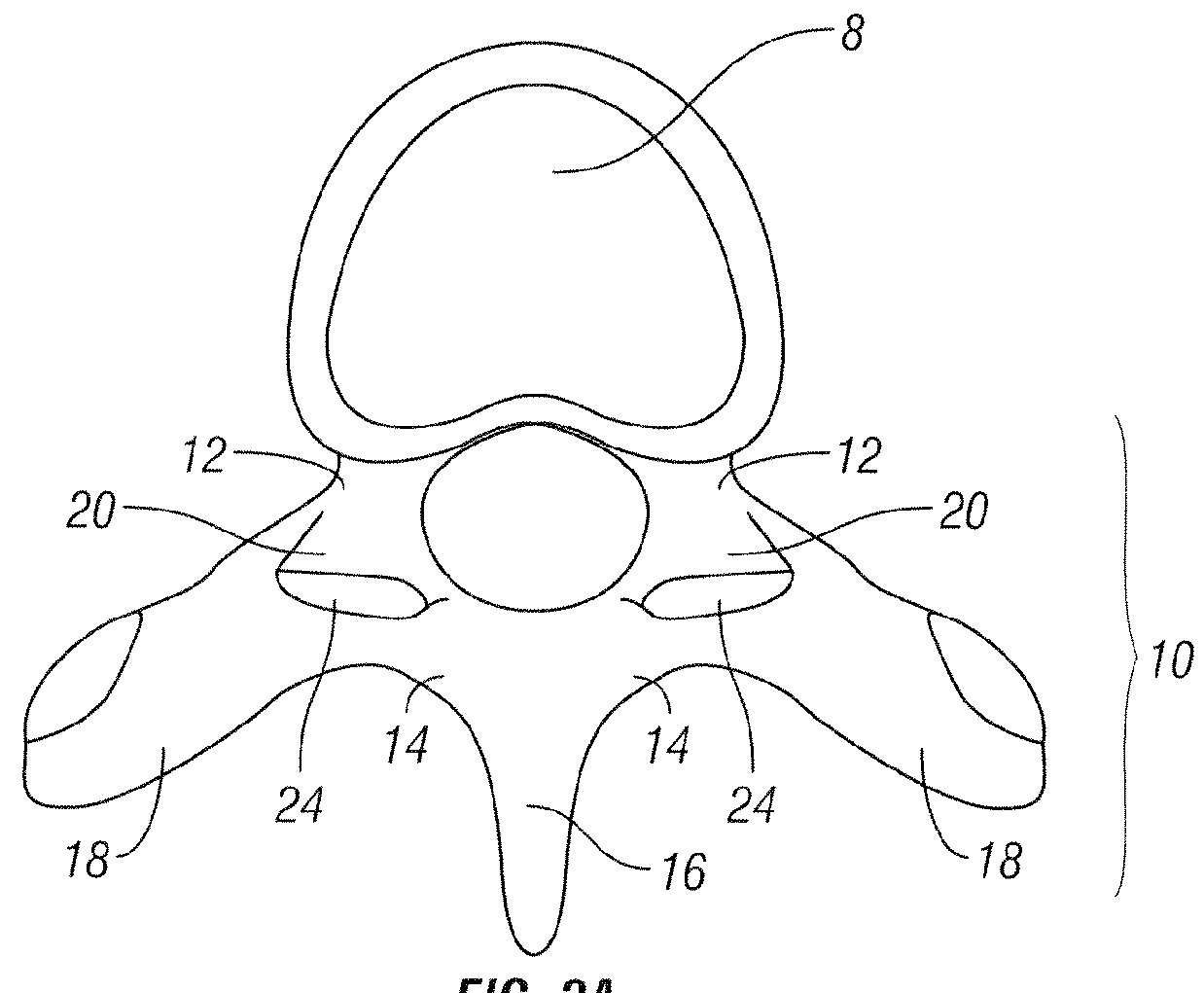 Method for accessing a spinal facet joint