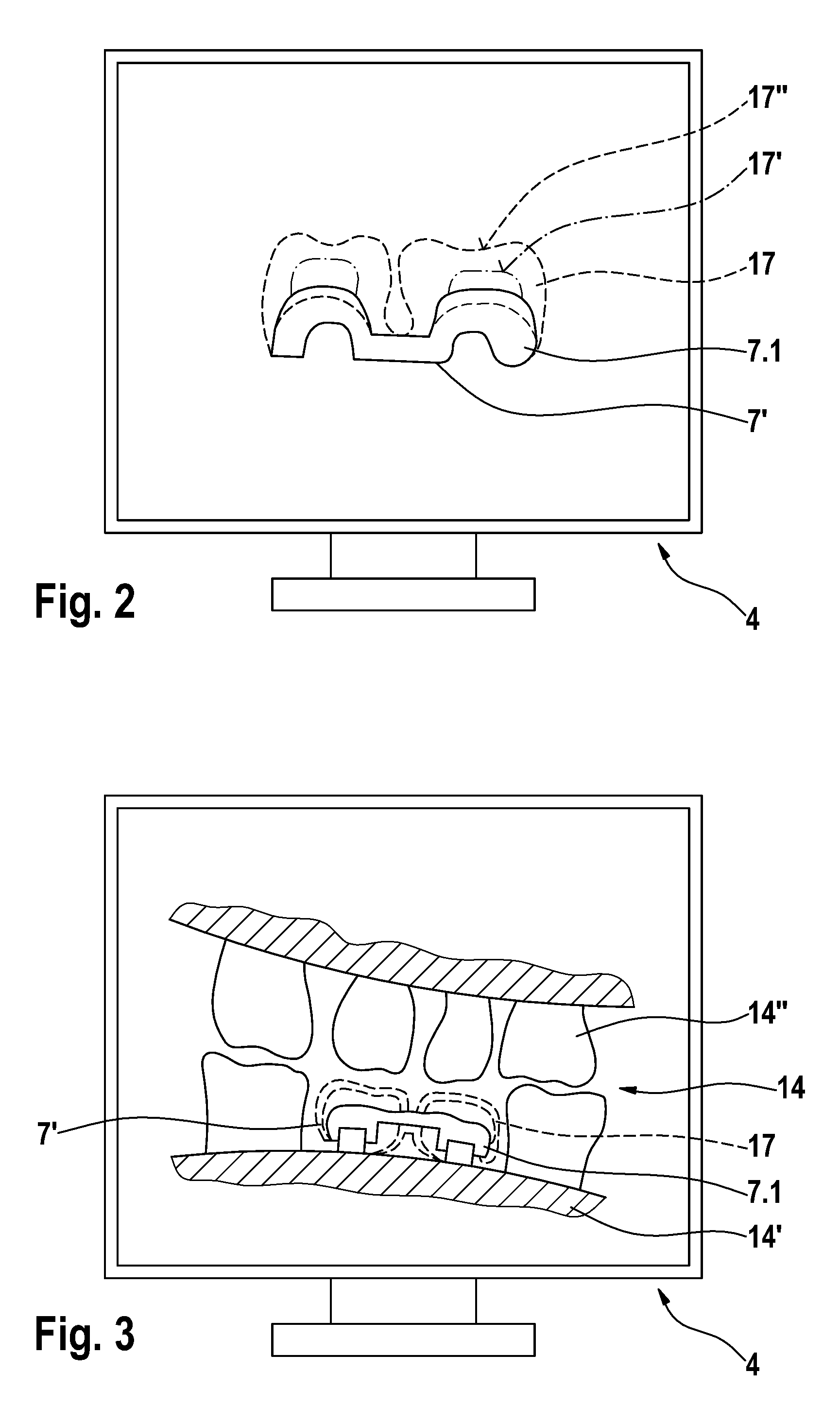 Method and device for producing dental prosthesis elements
