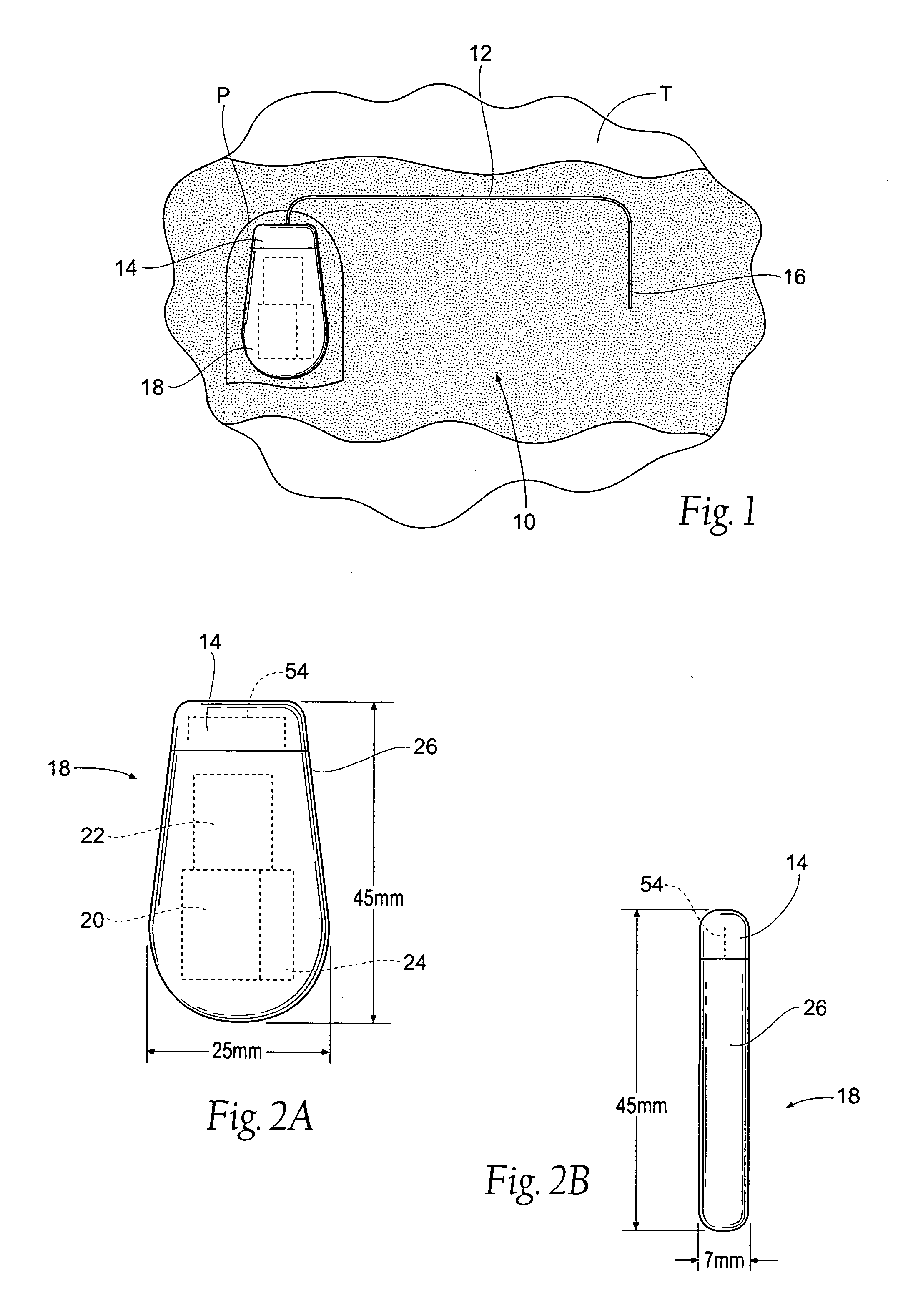 Implantable pulse generator for providing functional and/or therapeutic stimulation of muscles and /or nerves and/or central nervous system tissue