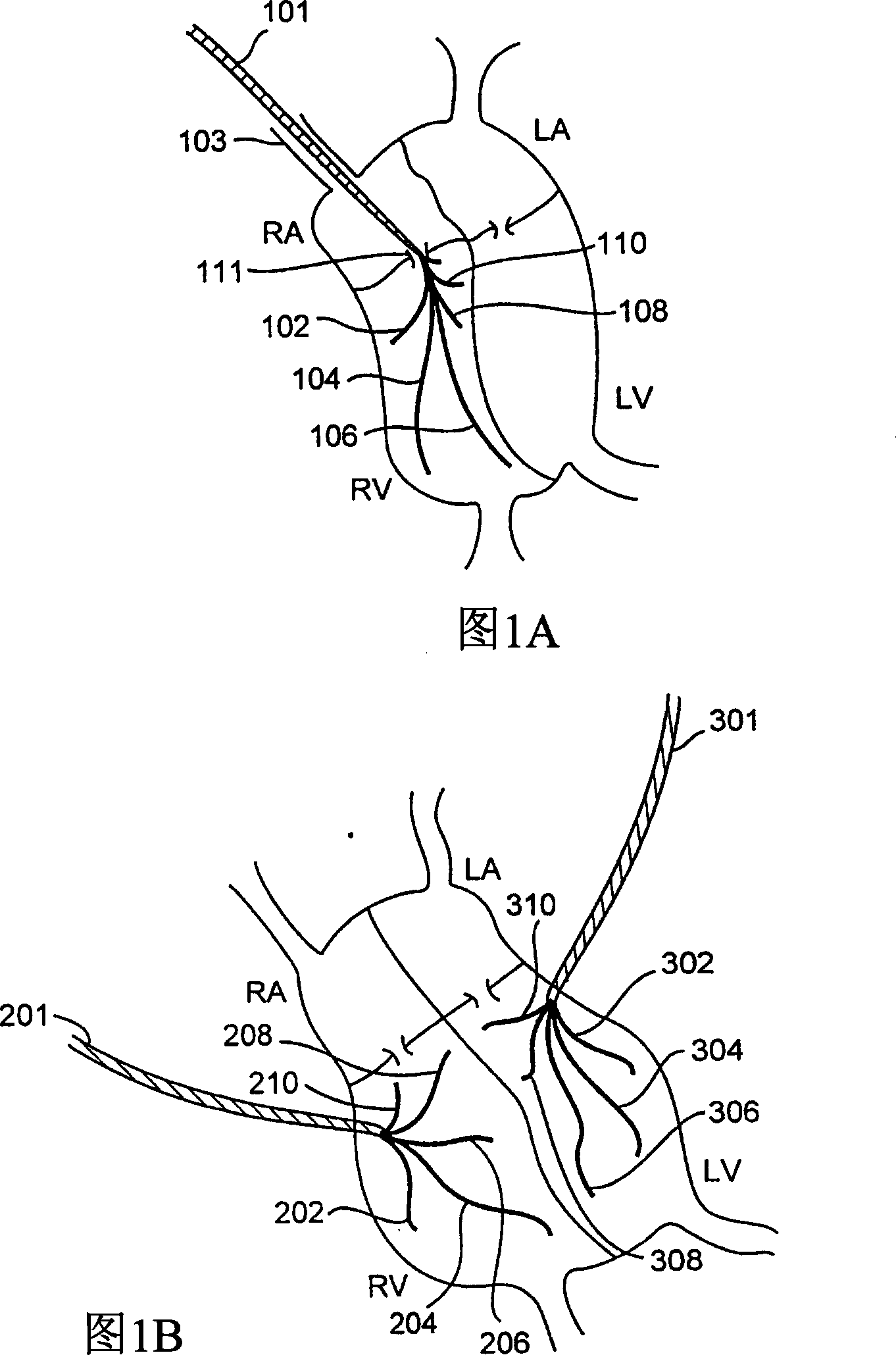System and method for multiple site biphasic stimulation to revert ventricular arrhythmias