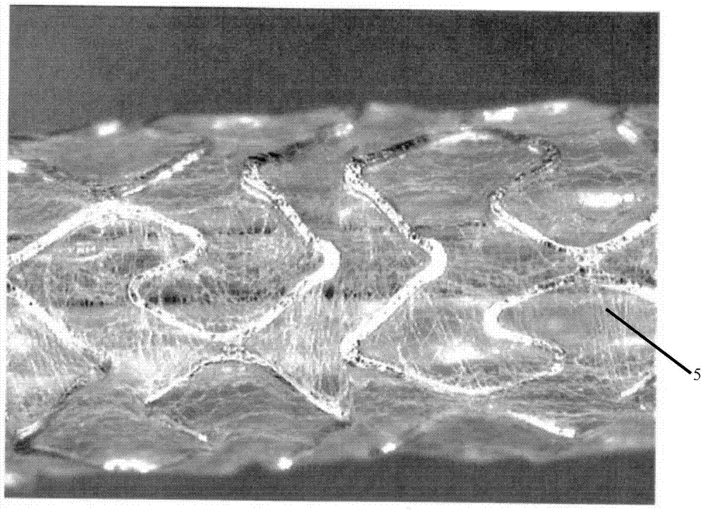 Spiral Hybrid Stent