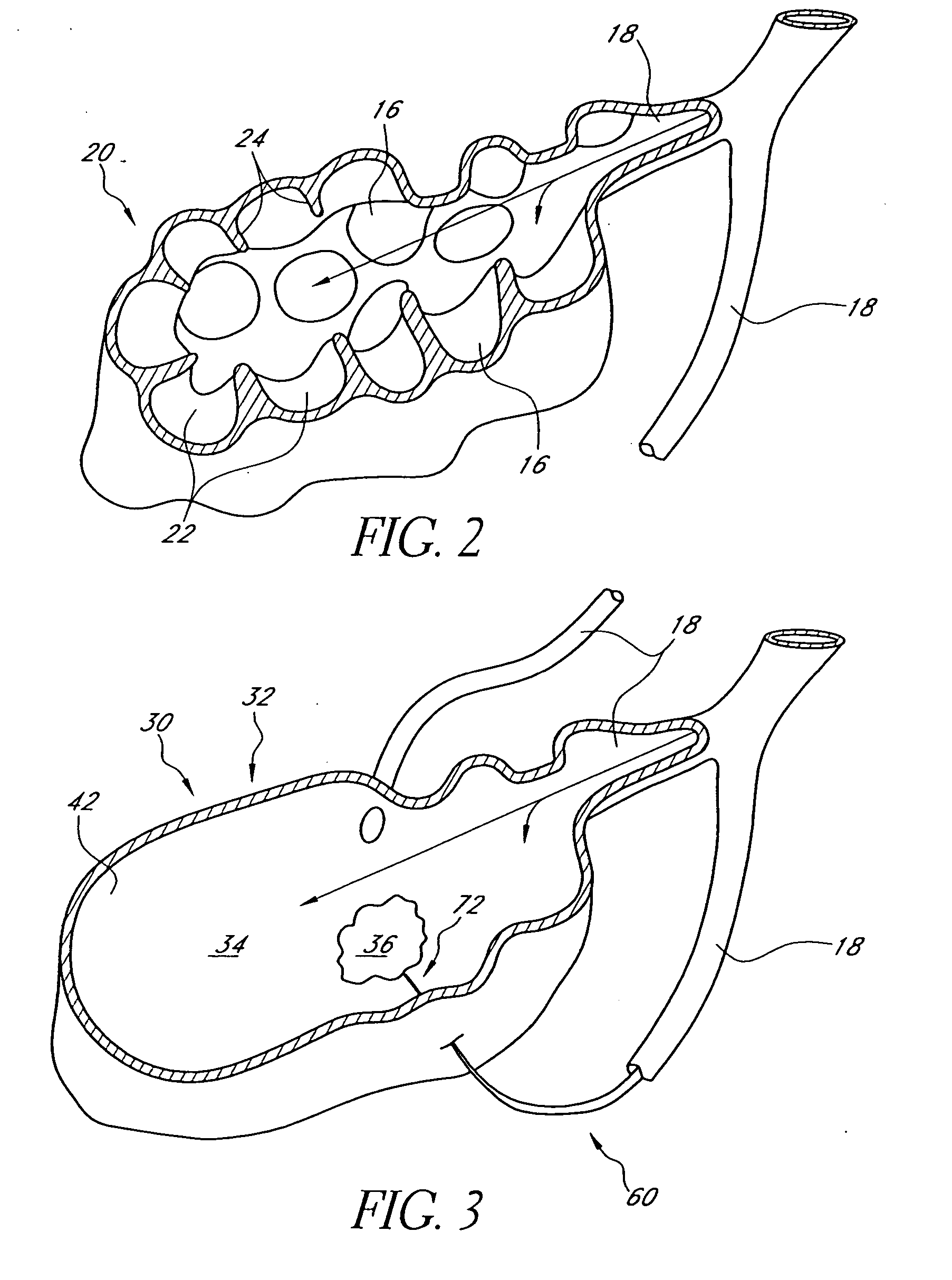 Bronchoscopic lung volume reduction method