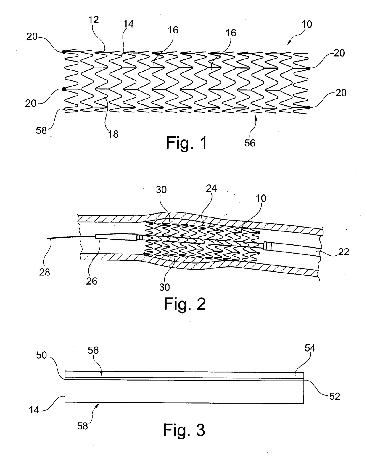 Implantable medical device with differentiated luminal and abluminal characteristics