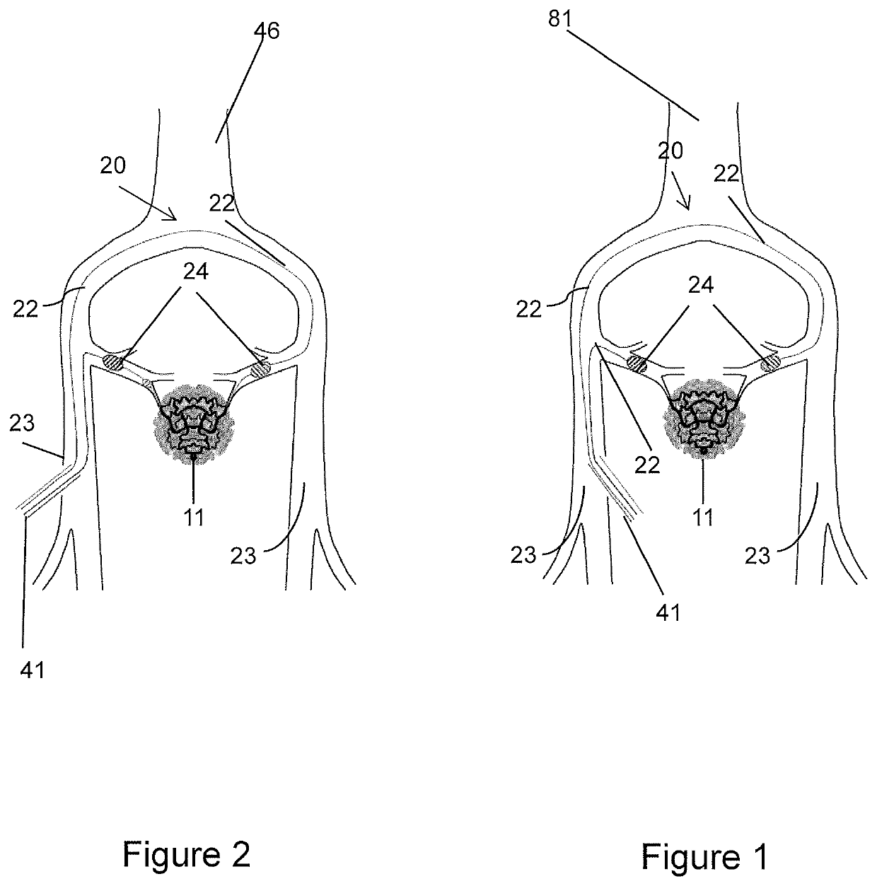 Devices and Methods for Vascular Hyperperfusion of Extravascular Space