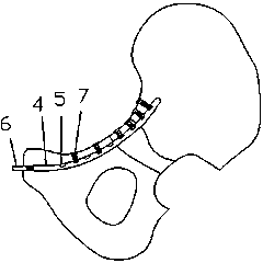 Pelvic fracture microinvasive intramedullary fixation device