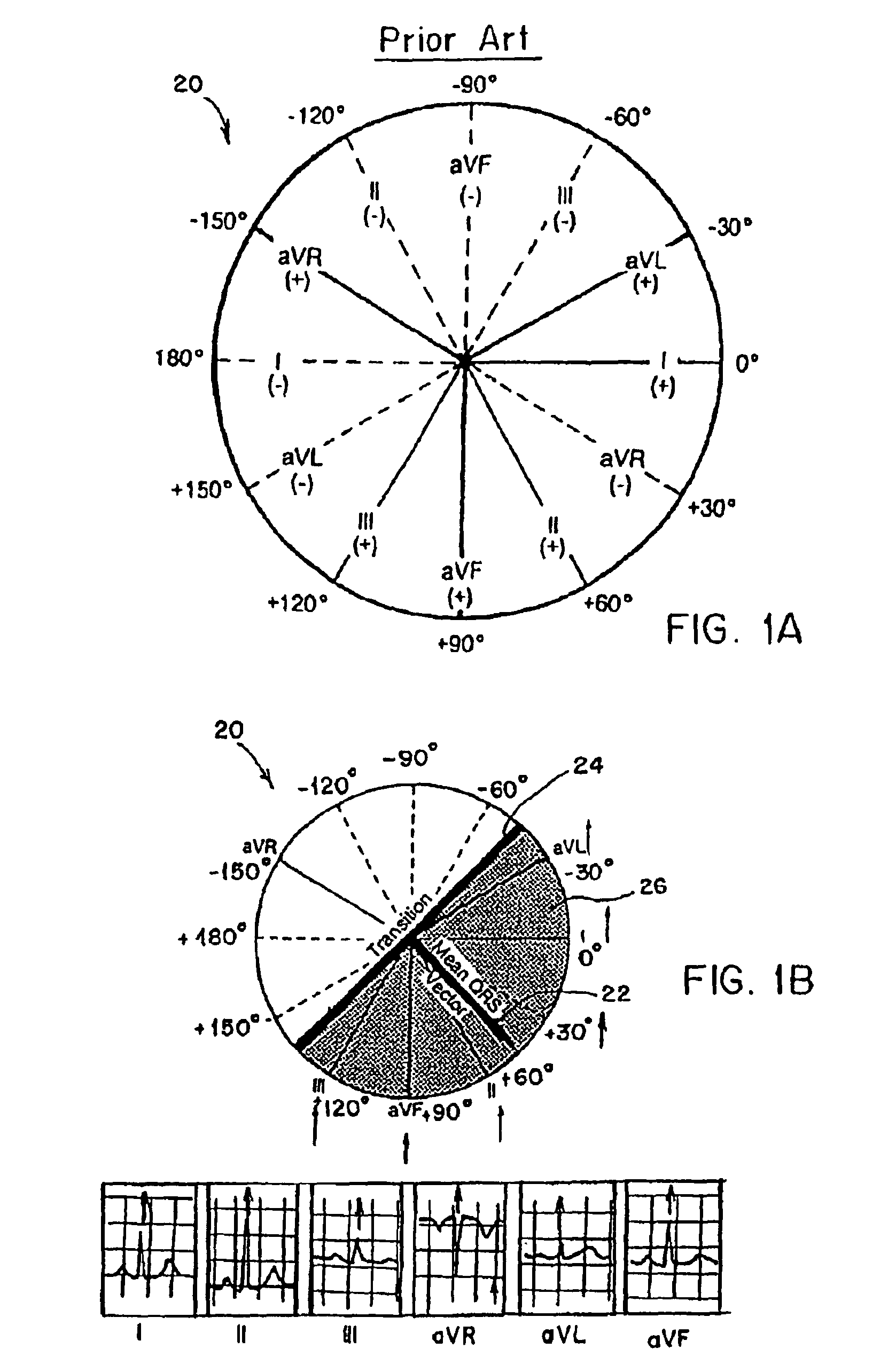 Three dimensional vector cardiograph and method for detecting and monitoring ischemic events