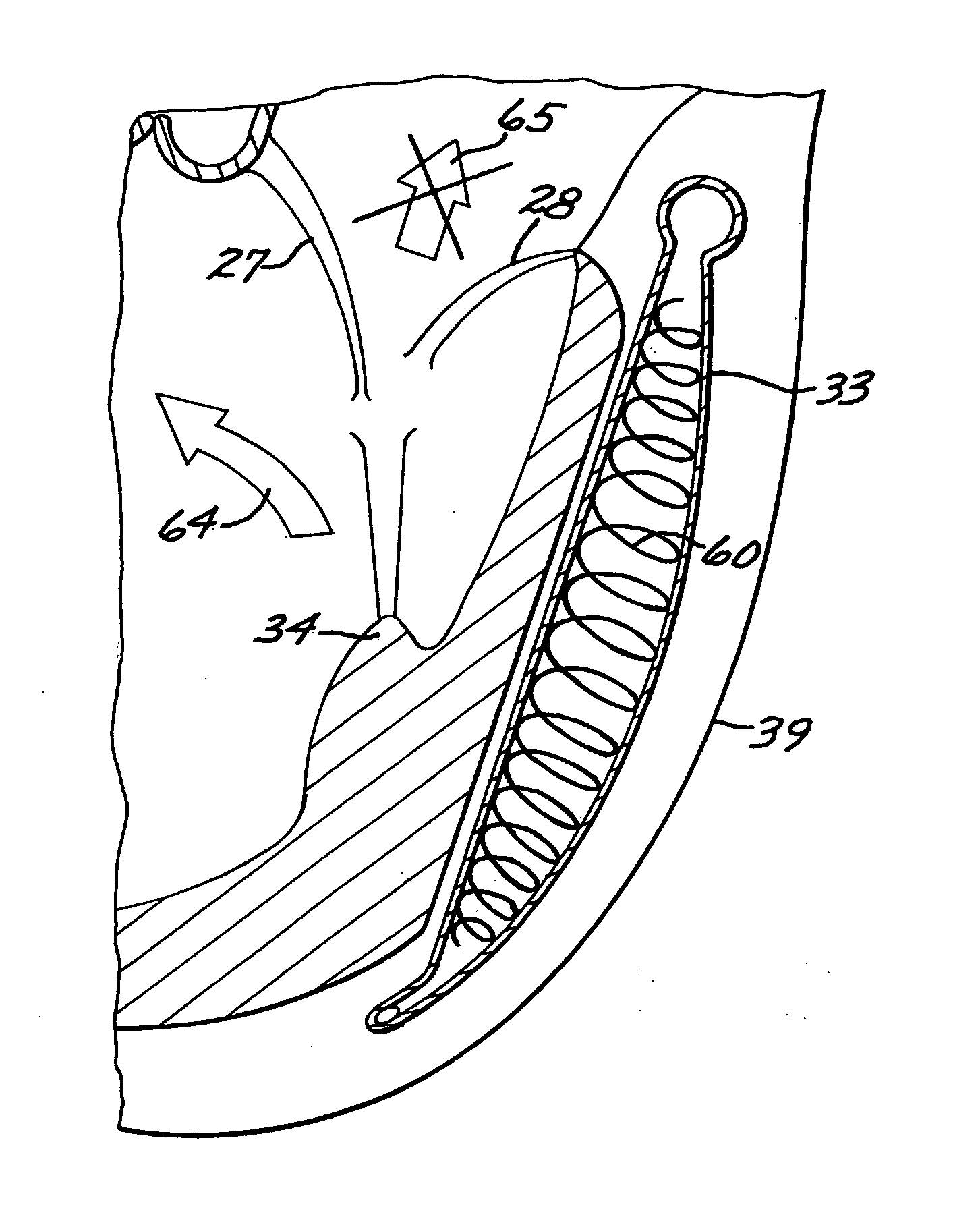 System, including method and apparatus for percutaneous endovascular treatment of functional mitral valve insufficiency