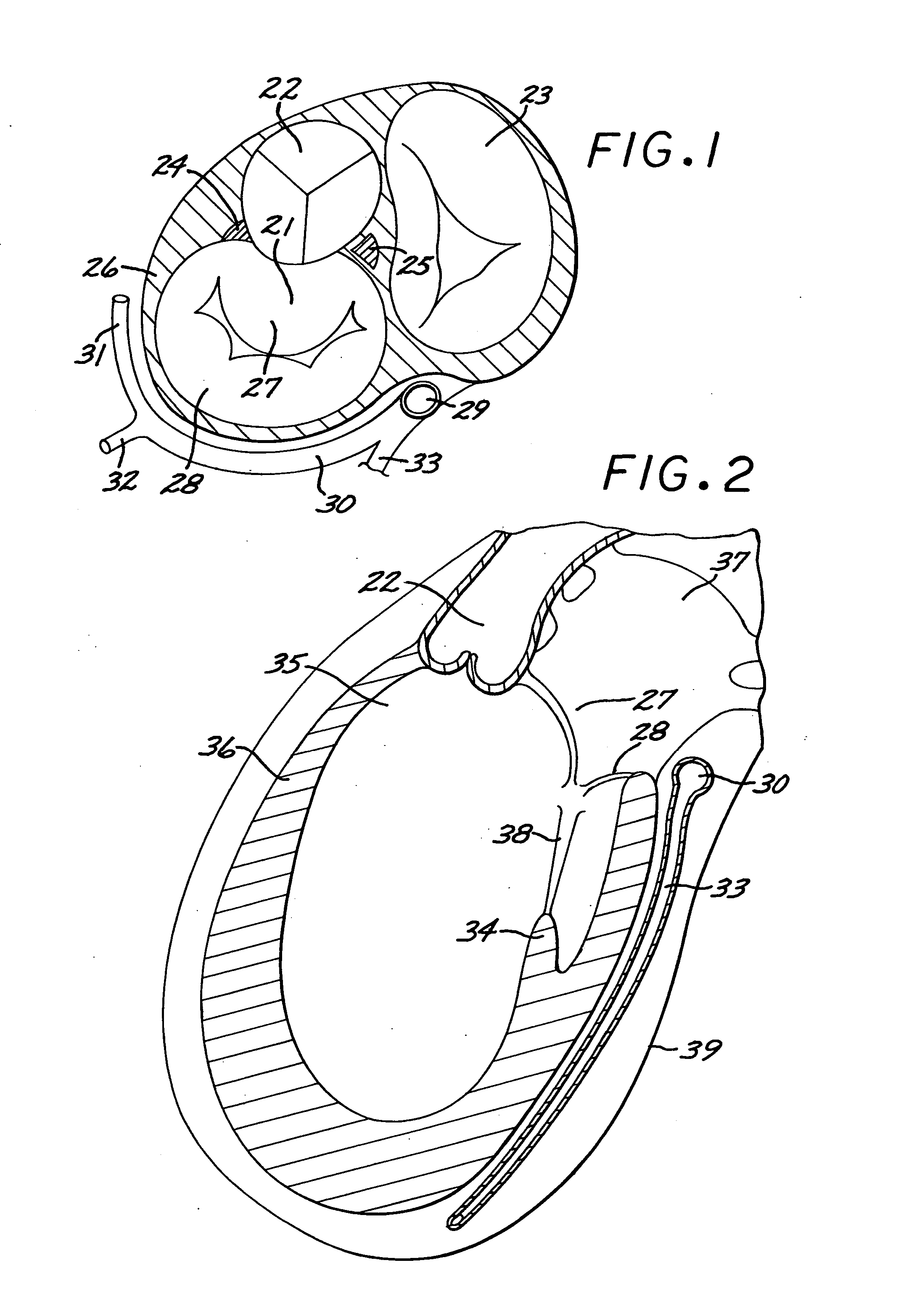 System, including method and apparatus for percutaneous endovascular treatment of functional mitral valve insufficiency