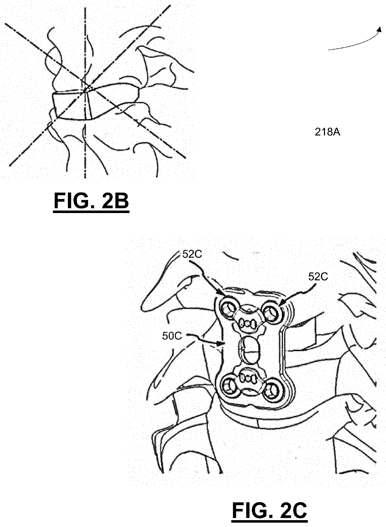 Hybrid spinal cages, systems and methods