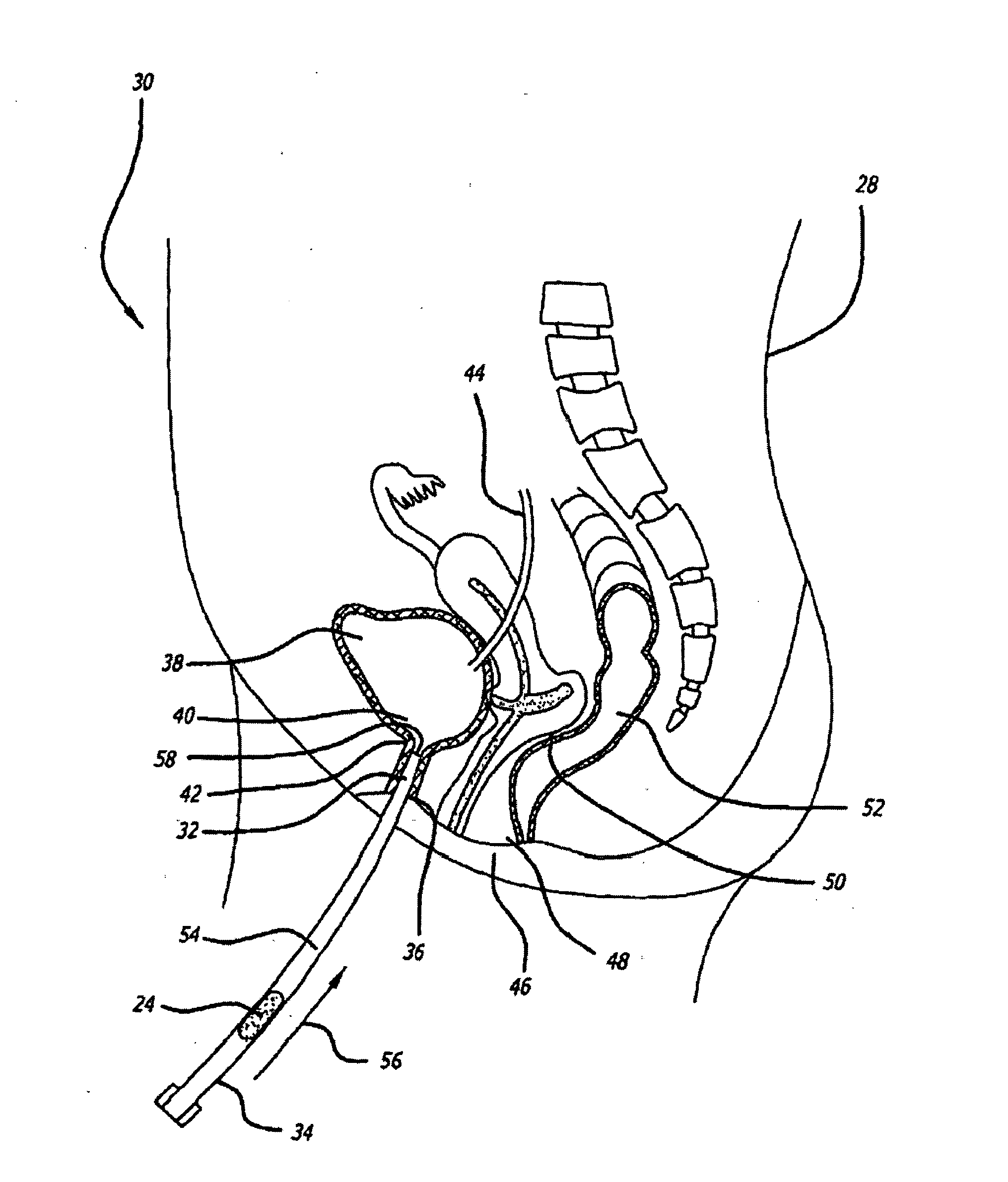 Transluminal drug delivery methods and devices