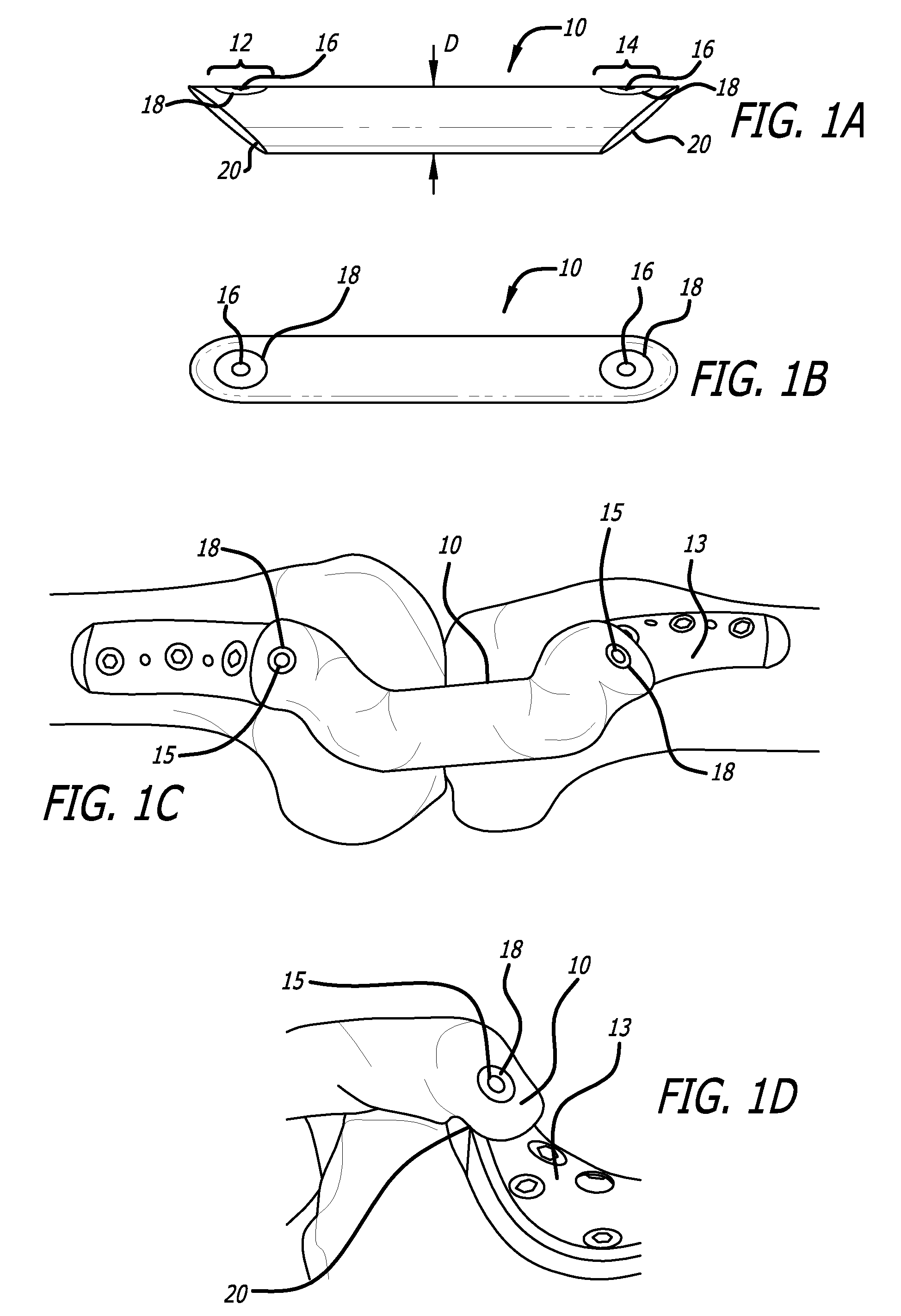 Sheaths for extra-articular implantable systems