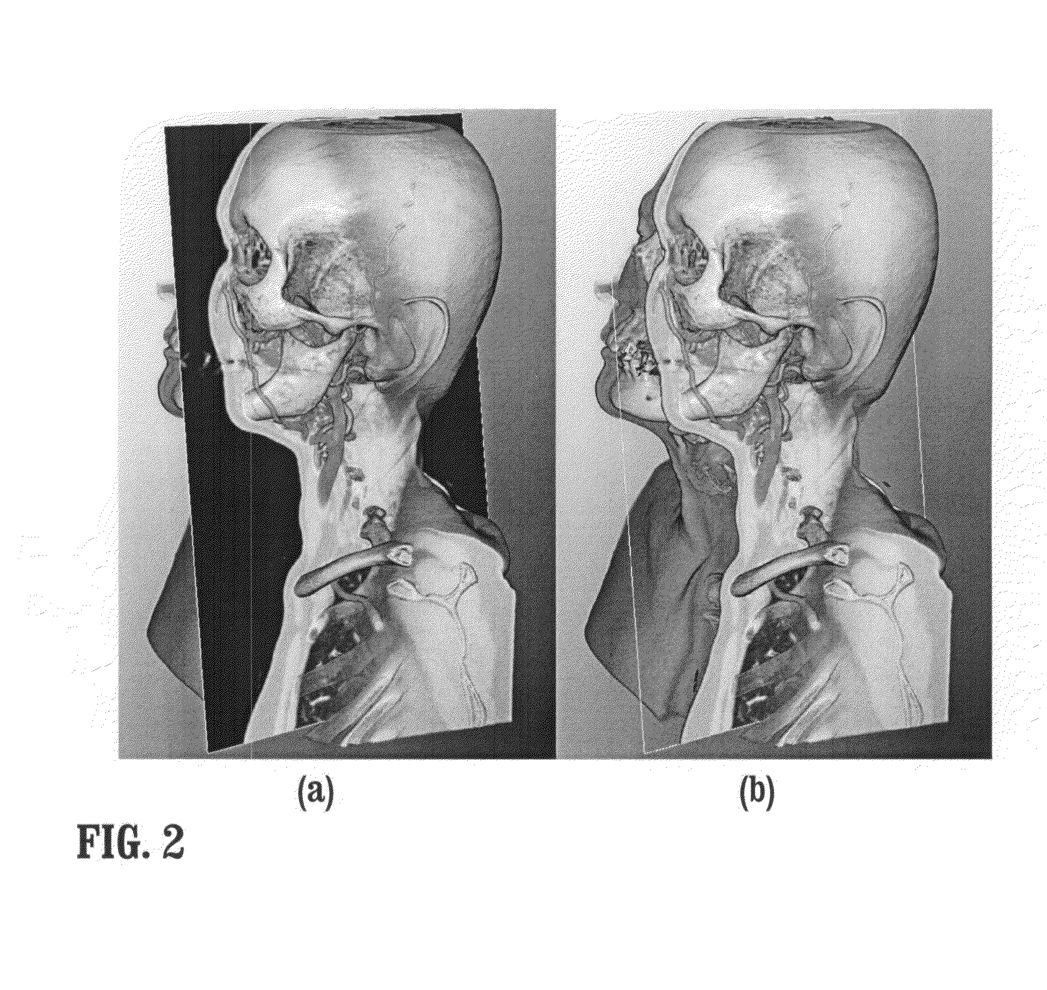 System and method for in-context MPR visualization using virtual incision volume visualization
