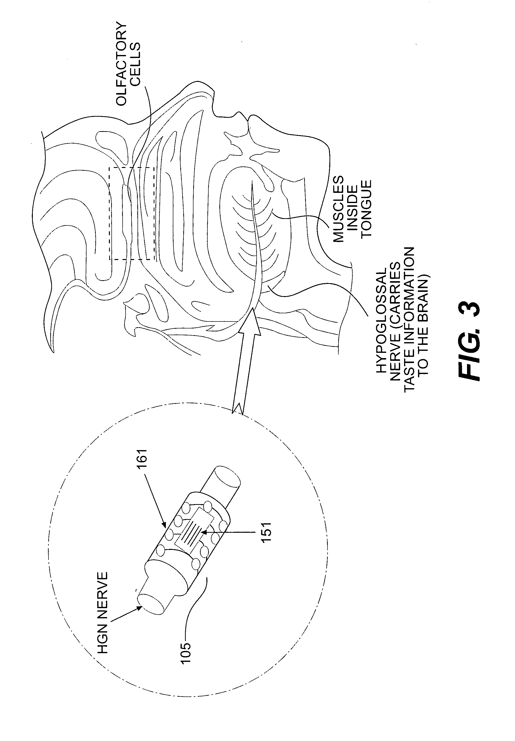 RFID-based apparatus, system, and method for therapeutic treatment of obstructive sleep apnea
