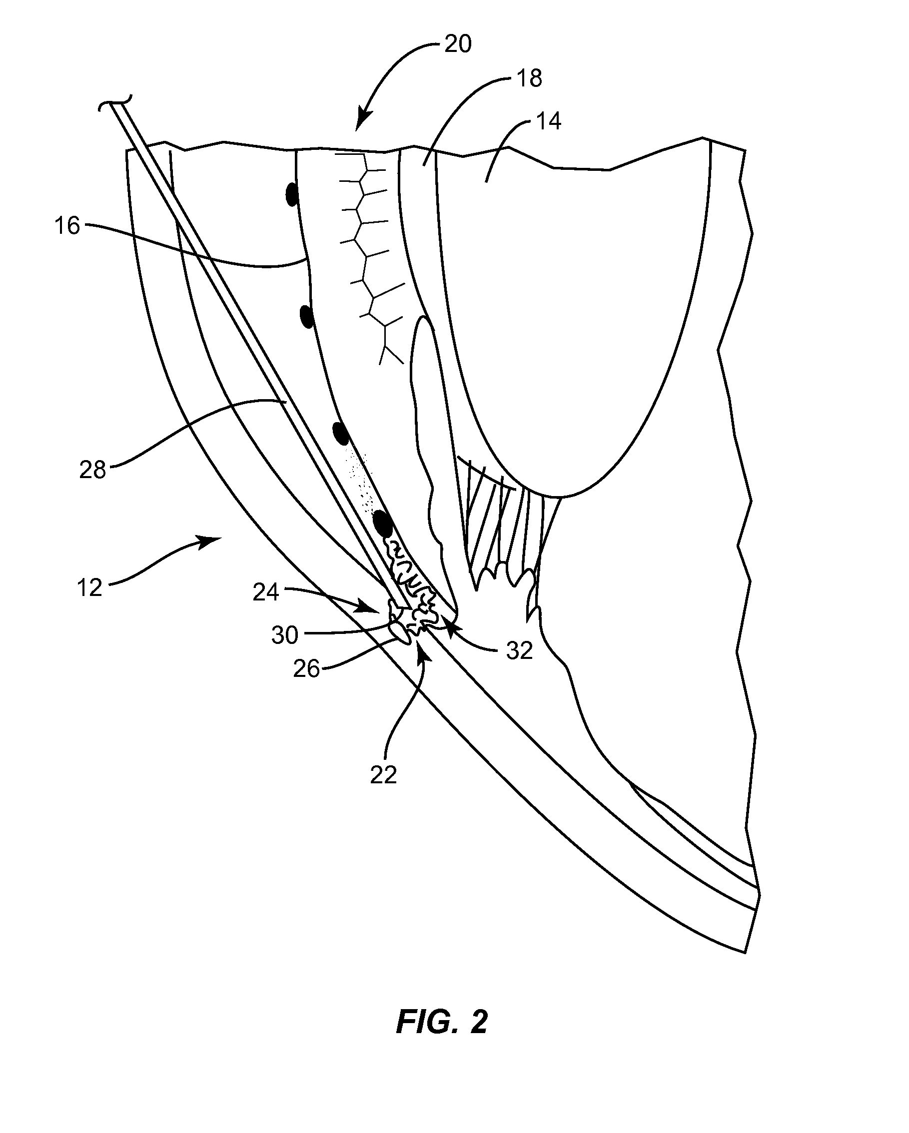 Methods, apparatuses, and systems for reducing intraocular pressure as a means of preventing or treating open-angle glaucoma