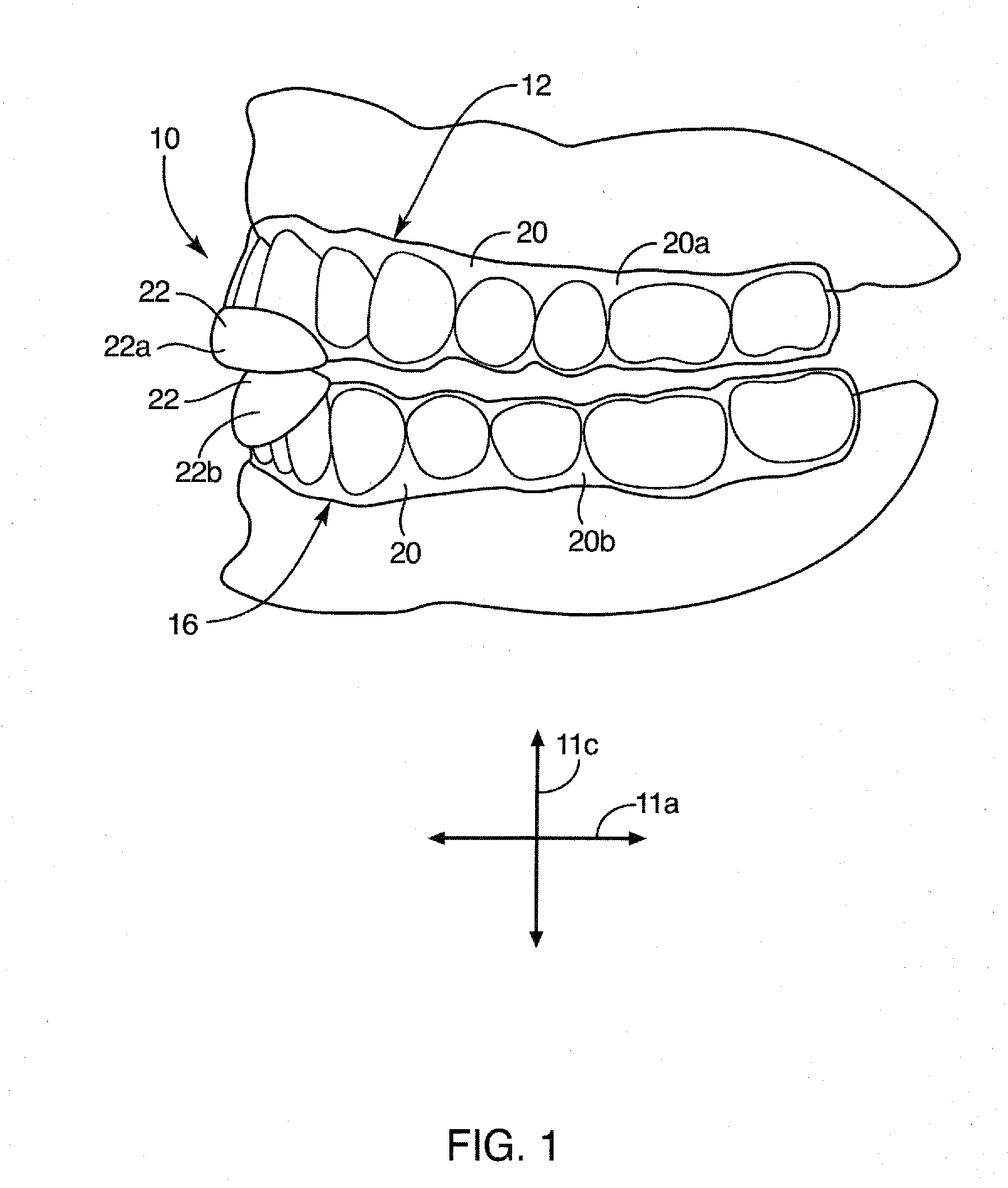 Dental appliance for treatment of bruxism