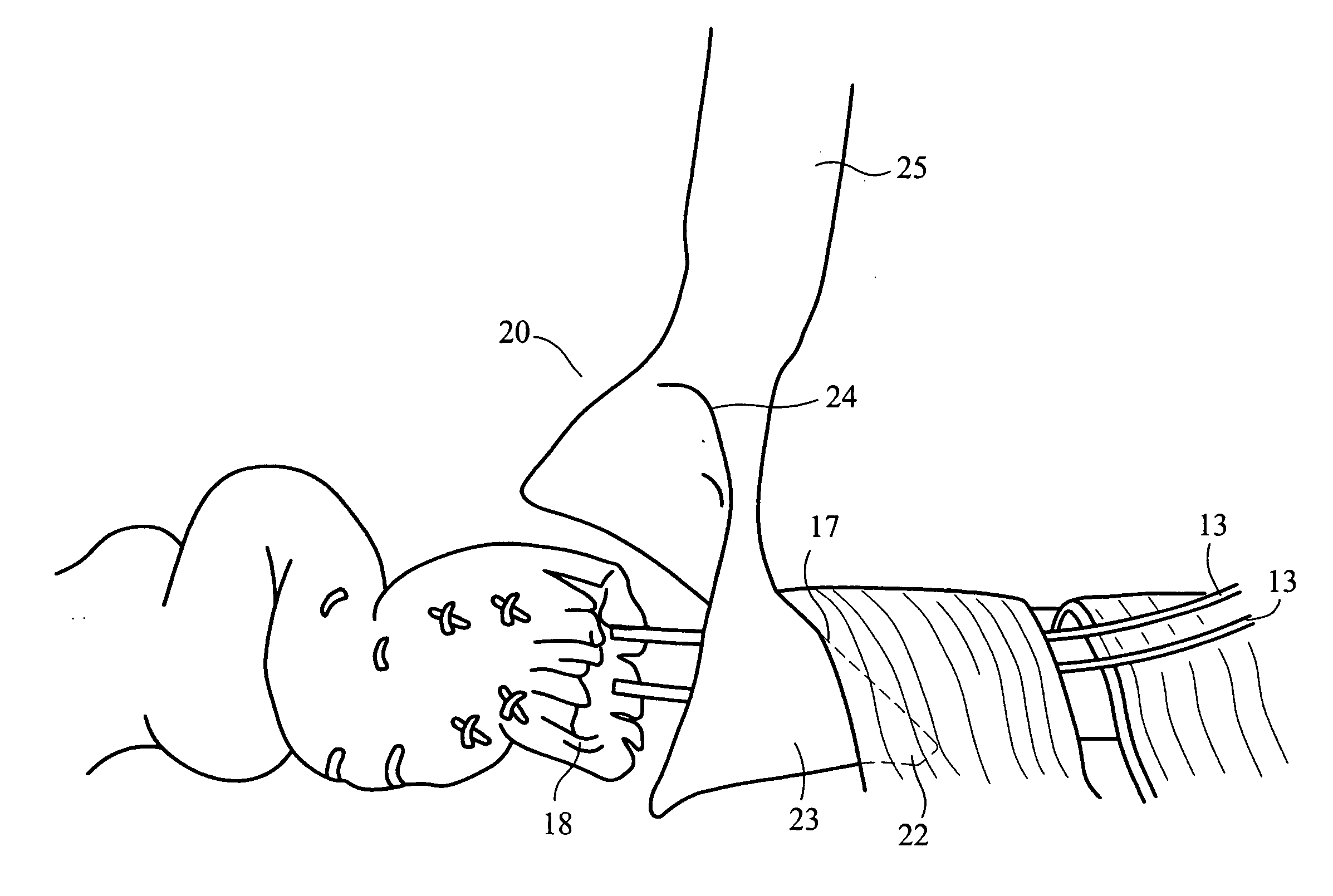 Device for assisting in flexor tendon repair and rehabilitation