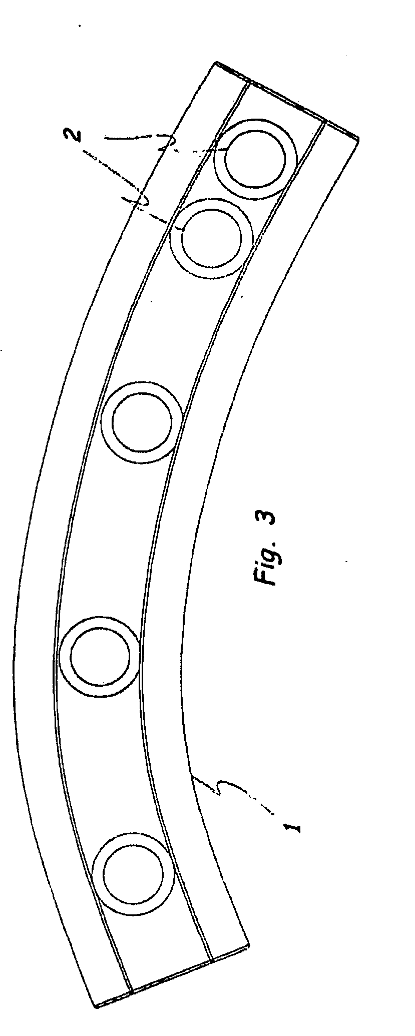 Method and system for the intramedullary fixation of a fractured bone