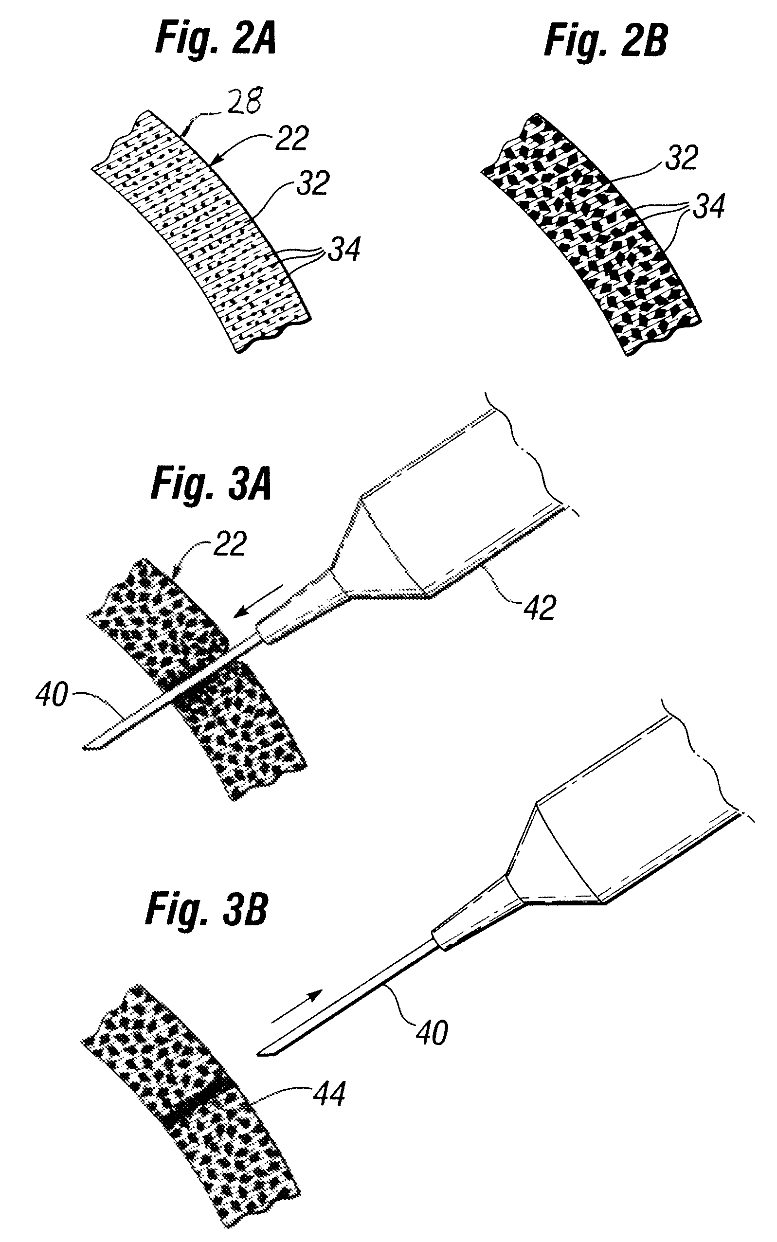 Self-sealing shell for inflatable prostheses