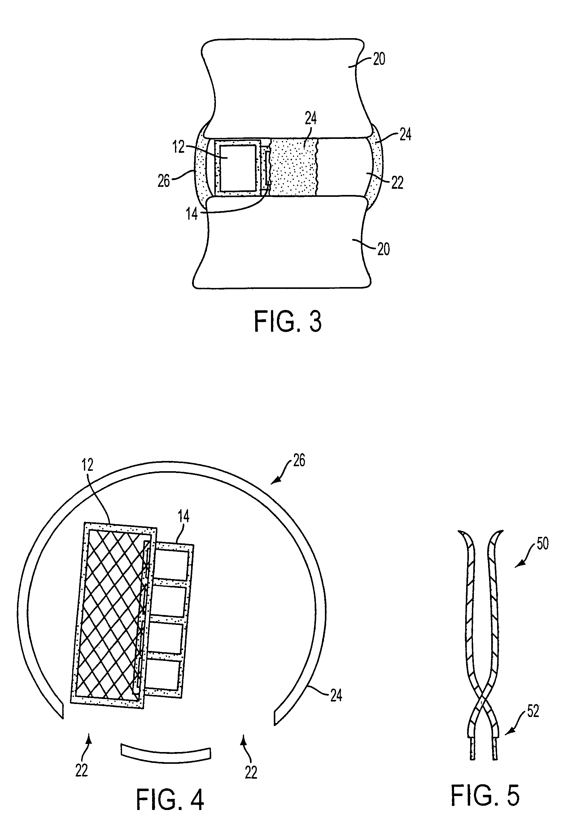 Lateral expandable interbody fusion cage