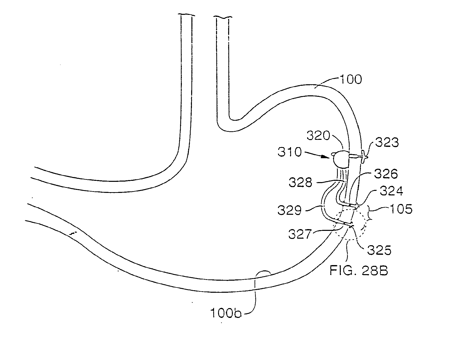 Gastric Simulation Anchor and Method