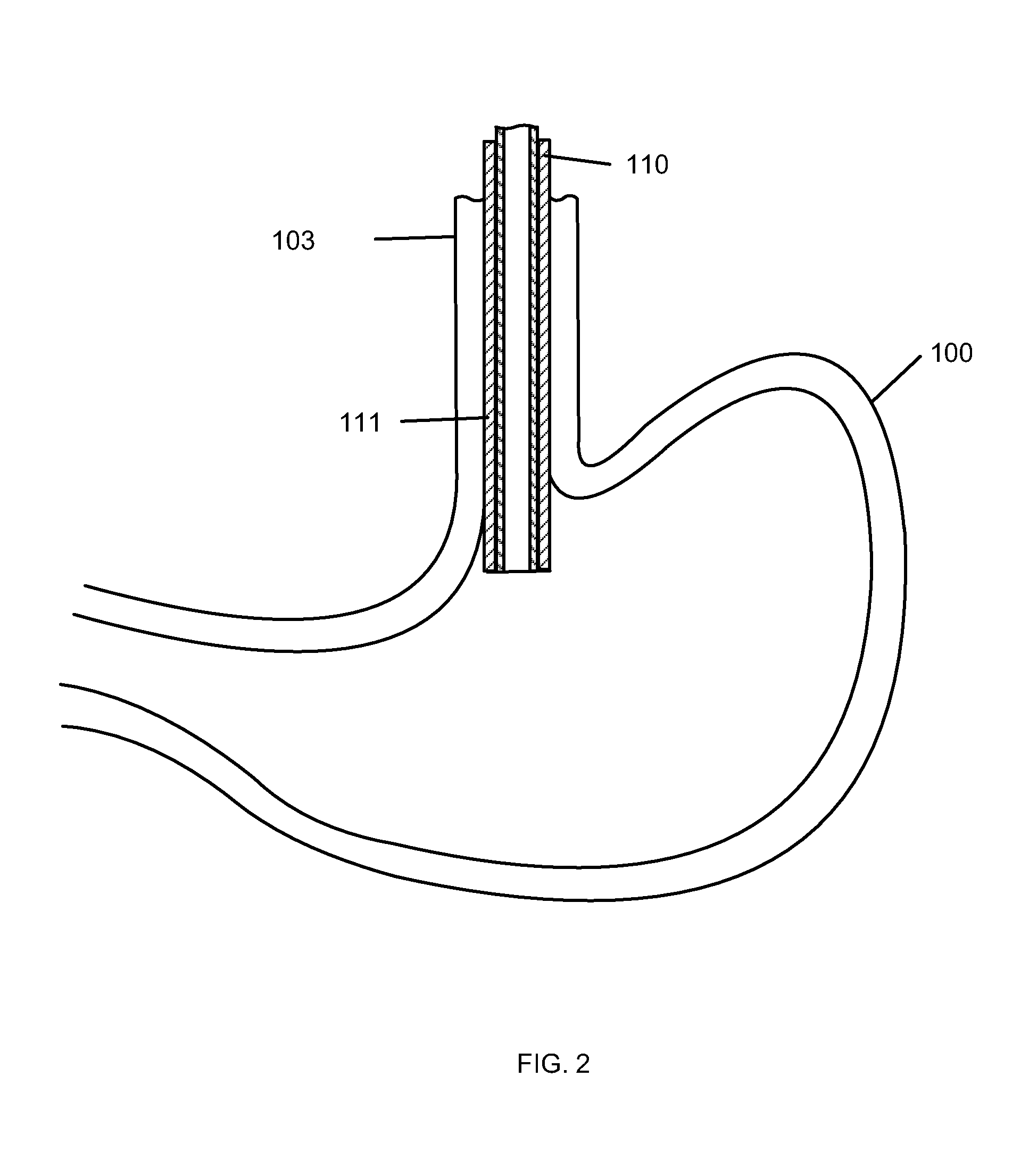 Gastric Simulation Anchor and Method